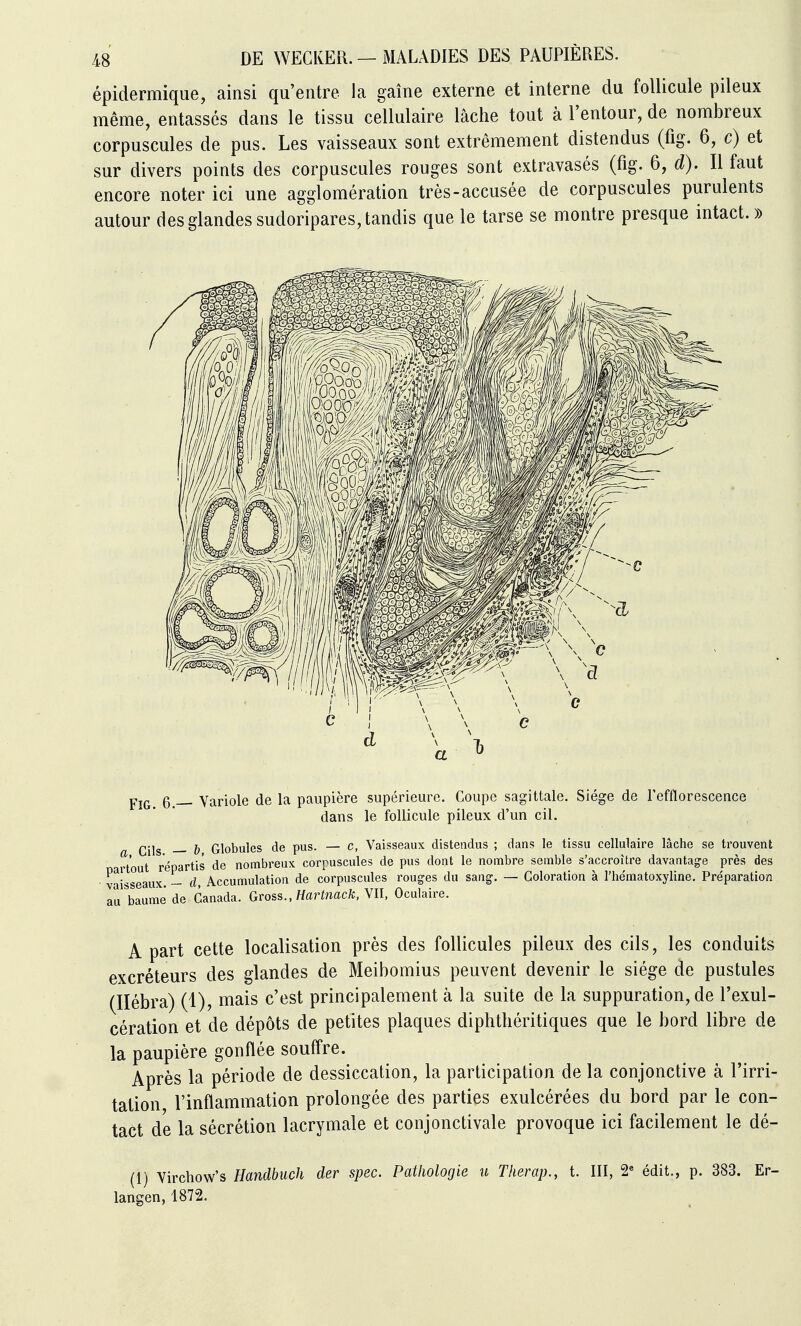 épidermique, ainsi qu'entre la gaine externe et interne du follicule t3ileux même, entassés dans le tissu cellulaire lâche tout à l'entour, de nombreux corpuscules de pus. Les vaisseaux sont extrêmement distendus (fig. 6, c) et sur divers points des corpuscules rouges sont extravasés (fig. 6, d). Il faut encore noter ici une agglomération très-accusée de corpuscules purulents autour des glandes sudoripares, tandis que le tarse se montre presque intact.» Pjg^ g_ Variole de la paupière supérieure. Coupe sagittale. Siège de refflorescence dans le follicule pileux d'un cil. Qjlg ^ Globules de pus. — c. Vaisseaux distendus ; dans le tissu cellulaire lâche se trouvent art'out répartis de nombreux corpuscules de pus dont le nombre semble s'accroître davantage près des vaisseaux. — d, Accumulation de corpuscules rouges du sang-. — Coloration à l'hématoxyline. Préparation lu baume de Canada. Gvoss., Hartnack, Yll, Oculaire. A part cette localisation près des follicules pileux des cils, les conduits excréteurs des glandes de Meibomius peuvent devenir le siège de pustules (Ilébra) (1), mais c'est principalement à la suite de la suppuration, de l'exul- cération et de dépôts de petites plaques diphthéritiques que le bord libre de la paupière gonflée souffre. Après la période de dessiccation, la participation de la conjonctive à l'irri- tation l'inflammation prolongée des parties exulcérées du bord par le con- tact de la sécrétion lacrymale et conjonctivale provoque ici facilement le dé- (1) Virchow's Handbuch der spec. PaUiologie u Tlierap., t. III, 2« édit., p. 383. Er- langen, 1872.