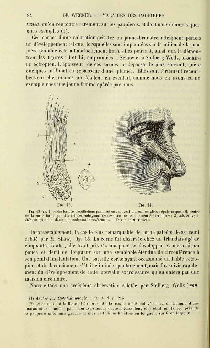 tanea, qu'on rencontre rarement sur les paupières, et dont nous donnons quel- ques exemples (i). Ces cornes d'une coloration grisâtre ou jaune-brunâtre atteignent parfois un développement tel que, lorsqu'elles sont implantées sur le milieu de la pau- pière (comme cela a habituellement lieu), elles peuvent, ainsi que le démon- trent les figures 13 et 14, empruntées à Schaw et à Sœlberg Wells, produire un ectropion. L'épaisseur de ces cornes ne dépasse, le plus souvent, guère quelques millimètres (épaisseur d'une plume). Elles sont fortement recour- bées sur elles-mêmes ou s'étalent en éventail, comme nous en avons eu un exemple chez une jeune femme opérée par nous. Fig'. 13 (2). 1, partie formée d'ëpithélium pavimenteux, souvent disposé en globes épidermiques ; 2, centre la corne formé par des cellules embryonnaires devenant très-rapidement épidermiques ; 3, vaisseaux ; 4, élément épithélial dentelé, constituant le revêtement. — Dessin de M. Poucet; Incontestablement, le cas le plus remarquable de corne palpébrale est celui relaté par M. Shaw, fig. 14. La corne fut observée chez un Irlandais âgé de cinquante-six afis ; elle avait pris six ans pour se développer et mesurait un pouce et demi de longueur sur une semblable étendue de circonférence à son point d'implantation. Une pareille corne ayant occasionné un faible ectro- pion et du larmoiement s'était éliminée spontanément, mais fut suivie rapide- ment du développement de cette nouvelle excroissance qu'on enleva par une incision circulaire. Nous citons une troisième observation relatée par Sœlberg Wells {voy. (1) Arcliiv fur Ophthalmologie, 1. X, A, 1, p. 215. (2) La corne dont la figure 13 représente la coupe a été enlevée chez un homme d'une quarantaine d'années par mon assistant le docteur Masselon; elle était implantée près de la paupière inférieure gauche et mesurait 15 millimètres en longueur sur 6 en largeur.