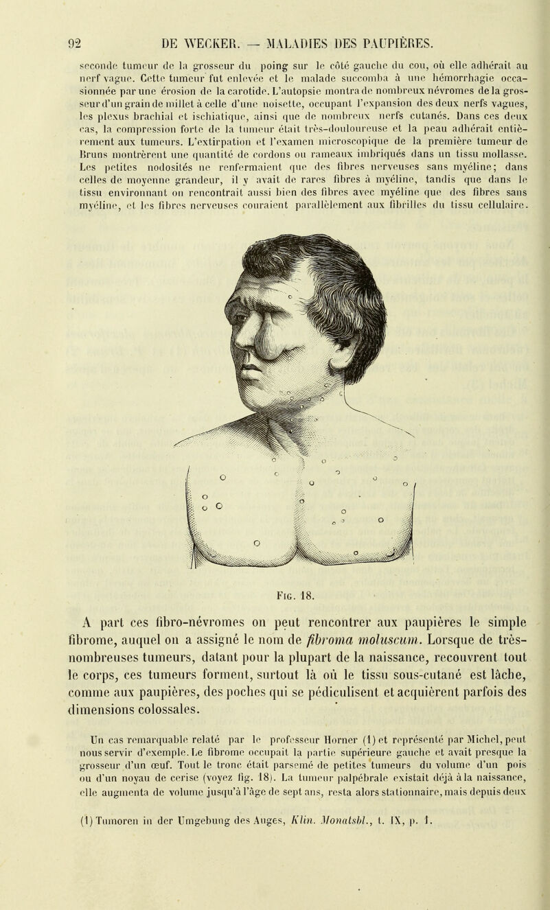seconde tumeur tic la grosseur du poing sur le côté gauche du cou, où elle adhérait au nerf vague. Cette tumeur fut enlevée et le malade succomba à une hémorrhagie occa- sionnée par une érosion de la carotide. L'autopsie montra de nombreux névromes delà gros- seur d'un grain de millet à celle d'une noisette, occupant l'expansion des deux nerfs vagues, les plexus brachial et ischiatique, ainsi que de nombreux nerfs cutanés. Dans ces deux cas, la compression forte de la tumeur était très-douloureuse et la peau adhérait entiè- rement aux tumeurs. L'extirpation et l'examen microscopique de la première tumeur de Bruns montrèrent une quantité de cordons ou rameaux imbriqués dans un tissu mollasse. Les petites nodosités ne renfermaient que des fibres nerveuses sans myéline; dans celles de moyenne grandeur, il y avait de rares fibres à myéline, tandis cfue dans le tissu environnant on rencontrait aussi bien des fibres avec myéline que des fibres sans myéline, et les fibres nerveuses couraient parallèlement aux fibrilles du tissu cellulaire. A part ces fibro-névromes on peut rencontrer aux paupières le simple fibrome, auquel on a assigné le nom de fibroma moluscum. Lorsque de très- nombreuses tumeurs, datant pour la plupart de la naissance, recouvrent tout le corps, ces tumeurs forment, surtout là où le tissu sous-cutané est lâche, comme aux paupières, des poches qui se pédiculisent et acquièrent parfois des dimensions colossales. Un cas remarquable relaté par le professeur Horner (1) et représenté par Michel, peut nous servir d'exemple. Le fibrome occupait la partie supérieure gauche et avait presque la grosseur d'un œuf. Tout le tronc était parsemé de petites tumeurs du volume d'un pois ou d'un noyau de cerise (voyez lîg. 18). La tumeur palpébrale existait déjà à la naissance, elle augmenta de volume jusqu'à l'âge de sept ans, resta alors stationnaire, mais depuis deux (l)Tumoren in der Umgebung des Auges, A7m. MonatshL, t. IX, p. 1. FiG. 18.
