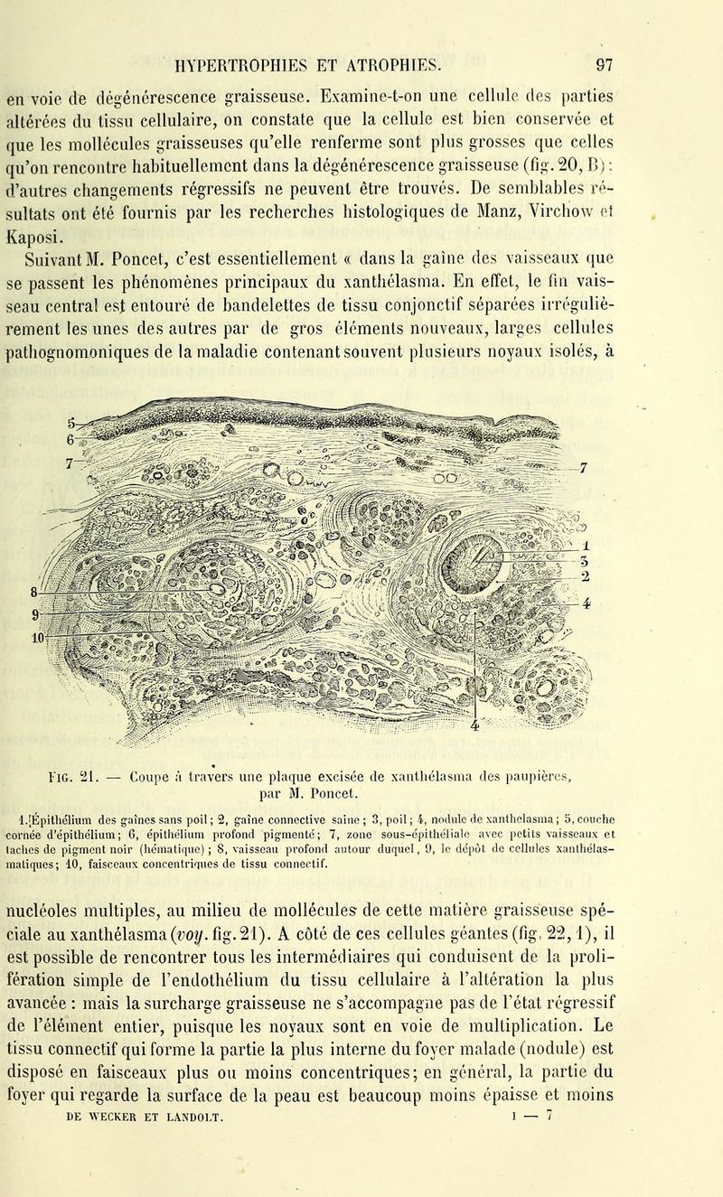 en voie de dégénérescence graisseuse. Examine-t-on une ceHiilo des parties altérées du tissu ceHulaire, on constate que la cellule est bien conservée et que les molléciiles graisseuses qu'elle renferme sont pins grosses que celles qu'on rencontre habituellement dans la dégénérescence graisseuse (fig. 20, B; : d'autres changements régressifs ne peuvent être trouvés. De semblables ré- sultats ont été fournis par les recherches histologiques de Manz, Virchow rî Kaposi. Suivant M. Poncet, c'est essentiellement « dans la gaine des vaisseaux (jue se passent les phénomènes principaux du xanthélasma. En effet, le fin vais- seau centra! est entouré de bandelettes de tissu conjonctif séparées irréguliè- rement les unes des autres par de gros éléments nouveaux, larges cellules pathognomoniques de la maladie contenant souvent plusieurs noyaux isolés, à l'iG. ^1. — Coupe à travers une plaque excisée de xaiithélasaia des paupières, par M. Poncet. l.[Épithélium des gaînes sans poil ; 2, gaine connective saine ; 3, poil ; 4, nodule de xanthélasma ; 5, couche cornée d'épithélium; 6, e'pithélium profond pigmenté; 7, zone sous-épithéliale avec petits vaisseaux et lâches de pigment noir (hématique) ; 8, vaisseau pi'ofond autour duquel, 9, le dépôt de cellules xanlhélas- maliques; 10, faisceaux concentriques de tissu connectif. nucléoles multiples, au milieu de mollécules- de cette matière graisseuse spé- ciale au xanthélasma (i^o?/. fig.21). A côté de ces cellules géantes (fig= 22,1), il est possible de rencontrer tous les intermédiaires qui conduisent de la proli- fération simple de l'endothéMum du tissu cellulaire à l'altération la plus avancée : mais la surcharge graisseuse ne s'accompagne pas de l'état régressif de l'élément entier, puisque les noyaux sont en voie de multiplication. Le tissu connectif qui forme la partie la plus interne du foyer malade (nodule) est disposé en faisceaux plus ou moins concentriques; en général, la partie du foyer qui regarde la surface de la peau est beaucoup moins épaisse et moins DE WECKER ET LANDOET. I — 7