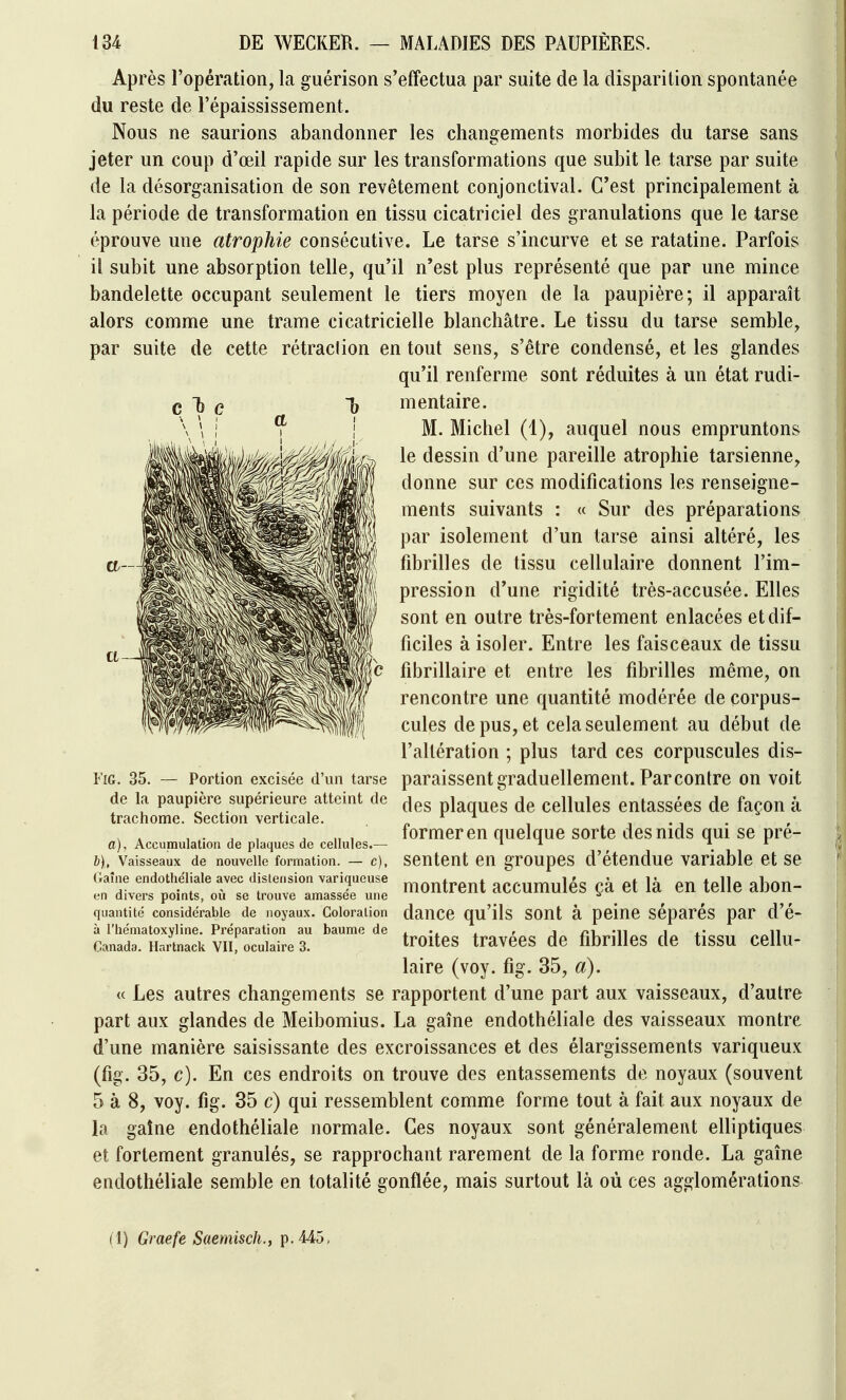 Après l'opération, la guérison s'effectua par suite de la disparition spontanée du reste de l'épaississement. Nous ne saurions abandonner les changements morbides du tarse sans jeter un coup d'œil rapide sur les transformations que subit le tarse par suite de la désorganisation de son revêtement conjonctival. C'est principalement à la période de transformation en tissu cicatriciel des granulations que le tarse éprouve une atrophie consécutive. Le tarse s'incurve et se ratatine. Parfois il subit une absorption telle, qu'il n'est plus représenté que par une mince bandelette occupant seulement le tiers moyen de la paupière; il apparaît alors comme une trame cicatricielle blanchâtre. Le tissu du tarse semble, par suite de cette rétraclion en tout sens, s'être condensé, et les glandes qu'il renferme sont réduites à un état rudi- mentaire. M. Michel (1), auquel nous empruntons le dessin d'une pareille atrophie tarsienne, donne sur ces modifications les renseigne- ments suivants : « Sur des préparations par isolement d'un tarse ainsi altéré, les fibrilles de tissu cellulaire donnent l'im- pression d'une rigidité très-accusée. Elles sont en outre très-fortement enlacées et dif- ficiles à isoler. Entre les faisceaux de tissu fibrillaire et entre les fibrilles même, on rencontre une quantité modérée de corpus- cules de pus, et cela seulement au début de l'altération ; plus tard ces corpuscules dis- paraissent graduellement. Par contre on voit des plaques de cellules entassées de façon à former en quelque sorte des nids qui se pré- sentent en groupes d'étendue variable et se montrent accumulés çà et là en telle abon- quantité considérable de noyaux. Coloration dailCC qu'ils SOUt à pcluC séparés par d'é- FiG. 35. — Portion excisée d'un tarse de la paupière supérieure atteint de trachome. Section verticale. a). Accumulation de plaques de cellules.— b). Vaisseaux de nouvelle formation. — c), Gaîne endothéliale avec distension variqueuse en divers points, où se trouve amassée une à l'hématoxyline. Préparation au baume de Canada. Hartnack VII, oculaire 3. troites travées de fibrilles de tissu cellu- laire (voy. fig. 35, a). « Les autres changements se rapportent d'une part aux vaisseaux, d'autre part aux glandes de Meibomius. La gaîne endothéliale des vaisseaux montre d'une manière saisissante des excroissances et des élargissements variqueux (fig. 35, c). En ces endroits on trouve des entassements de noyaux (souvent 5 à 8, voy. fig. 35 c) qui ressemblent comme forme tout à fait aux noyaux de la gaîne endothéliale normale. Ces noyaux sont généralement elliptiques et fortement granulés, se rapprochant rarement de la forme ronde. La gaîne endothéliale semble en totalité gonflée, mais surtout là où ces agglomérations (1) Giaefe Saemisch., p. 445,