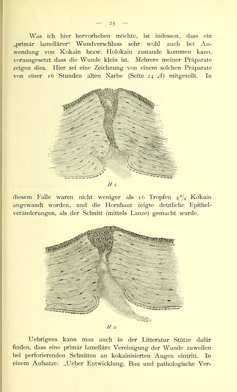 Was ich hier hervorheben möchte, ist indessen, dass ein „primär lamellärer Wundverschluss sehr wohl auch bei An- wendung von Kokain bezw. Holokain zustande kommen kann, vorausgesetzt dass die Wunde klein ist. Mehrere meiner Präparate zeigen dies. Hier sei eine Zeichnung von einem solchen Präparate von einer i6 Stunden alten Narbe (Seite 24 A) mitgeteilt. In JII. diesem Falle waren nicht weniger als 16 Tropfen 4*^/0 Kokain angewandt worden, und die Hornhaut zeigte deutliche Epithel- veränderungen, als der Schnitt (mittels Lanze) gemacht wurde. II 2. Uebrigens kann man auch in der Litteratur Stütze dafür finden, dass eine primär lamelläre Vereinigung der Wunde zuweilen bei perforierenden Schnitten an kokainisierten Augen eintritt. In einem Aufsatze: „Ueber Entwicklung, Bau und pathologische Ver-