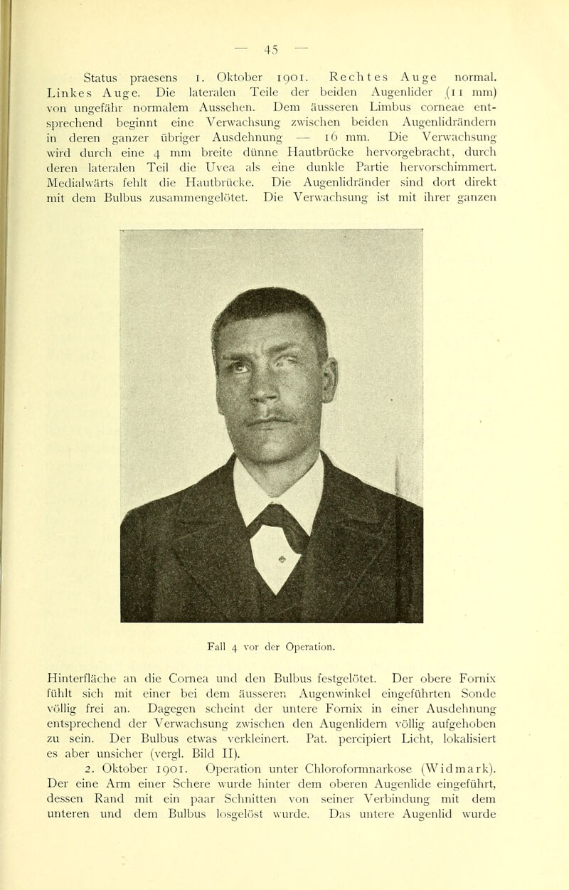 Status praesens i. Oktober 1901. Rechtes Auge normal. Linkes Auge. Die lateralen Teile der beiden Augenlider (11 mm) yon ungefähr normalem Aussehen. Dem äusseren Limbus corneae ent- spi'echend beginnt eine Verwachsung zwischen beiden Augenlidrändern in deren ganzer übriger Ausdehnung — i() mm. Die Verwachsung wird durch eine 4 mm breite dünne Hautbrücke her\orgebracht, durch deren lateralen Teil die Uvea als eine dunkle Partie hervorschimmert. Medialwärts fehlt die Hautbrücke. Die Augenlidränder sind dort direkt mit dem Bulbus zusammengelötet. Die Verwachsung ist mit ihrer ganzen Fall 4 vor der Operation. Hinterfläche an die Cornea und den Bulbus festgelötet. Der obere Fornix fühlt sich mit einer bei dem äusseren Augenwinkel eingeführten Sonde völlig frei an. Dagegen scheint der untere Fornix in einer Ausdehnung entsprechend der Verwachsung zwischen den Augenlidern \'öllig aufgehoben zu sein. Der Bulbus etwas \'crkleincrt. Fat. percipiert Licht, lokalisiert es aber unsicher (\-ergl. Bild H). 2. Oktober igoi. Operation unter Chloroformnarkose (Widmark). Der eine Amr einer Schere wurde hinter dem oberen Augenlide eingeführt, dessen Rand mit ein paar Schnitten von seiner Verbindung mit dem unteren und dem Bulbus losgelöst wurde. Das untere Augenlid wurde