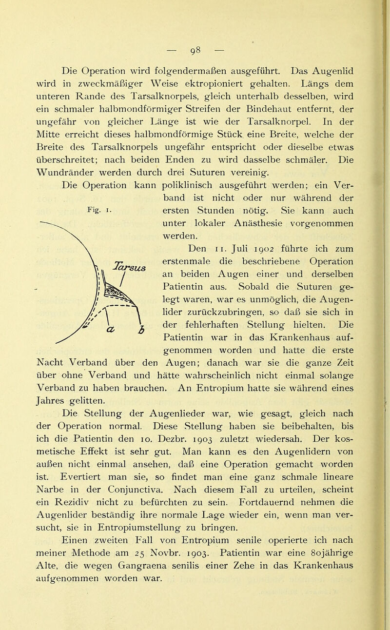 Die Operation wird folgendermaßen ausgeführt. Das Augenlid wird in zweckmäßiger Weise ektropioniert gehalten. Längs dem unteren Rande des Tarsalknorpels, gleich unterhalb desselben, wird ein schmaler halbmondförmiger Streifen der Bindehaut entfernt, der ungefähr von gleicher Länge ist wie der Tarsalknorpel. In der Mitte erreicht dieses halbmondförmige Stück eine Breite, welche der Breite des Tarsalknorpels ungefähr entspricht oder dieselbe etwas überschreitet; nach beiden Enden zu wird dasselbe schmäler. Die Wundränder werden durch drei Suturen vereinig. Die Operation kann poliklinisch ausgeführt werden; ein Ver- band ist nicht oder nur während der Fig. I. ersten Stunden nötig. Sie kann auch unter lokaler Anästhesie vorgenommen werden. Den II. Juli 1902 führte ich zum erstenmale die beschriebene Operation an beiden Augen einer und derselben Patientin aus. Sobald die Suturen ge- legt waren, war es unmöglich, die Augen- lider zurückzubringen, so daß sie sich in der fehlerhaften Stellung hielten. Die Patientin war in das Krankenhaus auf- genommen worden und hatte die erste Nacht Verband über den Augen; danach war sie die ganze Zeit über ohne Verband und hätte wahrscheinlich nicht einmal solange Verband zu haben brauchen. An Entropium hatte sie während eines Jahres gelitten. Die Stellung der Augenlieder war, wie gesagt, gleich nach der Operation normal. Diese Stellung haben sie beibehalten, bis ich die Patientin den 10. Dezbr. 1903 zuletzt wiedersah. Der kos- metische Effekt ist sehr gut. Man kann es den Augenlidern von außen nicht einmal ansehen, daß eine Operation gemacht worden ist. Evertiert man sie, so findet man eine ganz schmale lineare Narbe in der Conjunctiva. Nach diesem Fall zu urteilen, scheint ein Rezidiv nicht zu befürchten zu sein. Fortdauernd nehmen die Augenlider beständig ihre normale Lage wieder ein, wenn man ver- sucht, sie in Entropiumstellung zu bringen. Einen zweiten P'all von Entropium senile operierte ich nach meiner Methode am 25 Novbr. 1903. Patientin war eine 80jährige Alte, die wegen Gangraena senilis einer Zehe in das Krankenhaus aufgenommen worden war.