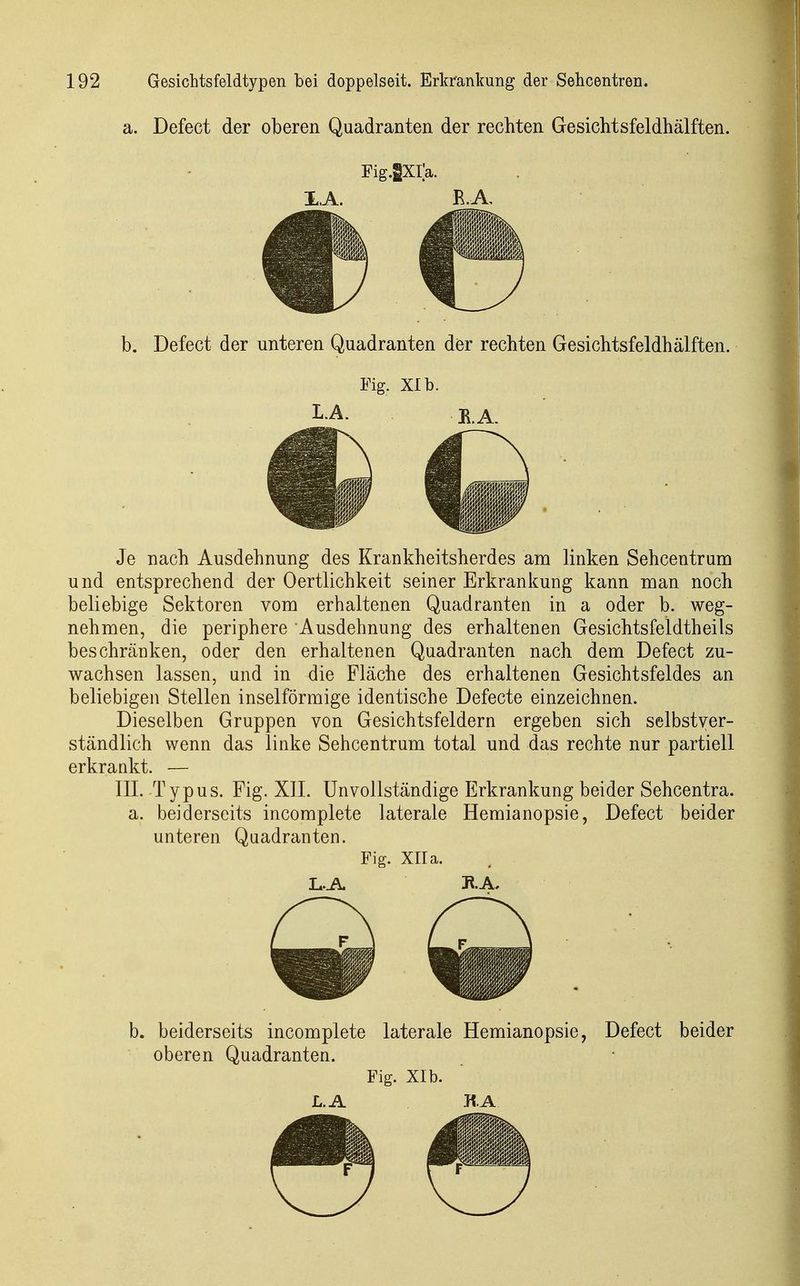 a. Defect der oberen Quadranten der rechten Gesichtsfeldhälften. Fig.lXra. b. Defect der unteren Quadranten der rechten Gesichtsfeldhälften. Fig. XI b. I-A. E. A. Je nach Ausdehnung des Krankheitsherdes am linken Sehcentrum und entsprechend der Oertlichkeit seiner Erkrankung kann man noch beliebige Sektoren vom erhaltenen Quadranten in a oder b. weg- nehmen, die periphere Ausdehnung des erhaltenen Gesichtsfeldtheils beschränken, oder den erhaltenen Quadranten nach dem Defect zu- wachsen lassen, und in die Fläche des erhaltenen Gesichtsfeldes an beliebigen Stellen inselförmige identische Defecte einzeichnen. Dieselben Gruppen von Gesichtsfeldern ergeben sich selbstver- ständlich wenn das linke Sehcentrum total und das rechte nur partiell erkrankt. — III. Typus. Fig. XII. Unvollständige Erkrankung beider Sehcentra. a. beiderseits incomplete laterale Hemianopsie, Defect beider unteren Quadranten. Fig. Xlla. L.A. J^.A, b. beiderseits incomplete laterale Hemianopsie, Defect beider oberen Quadranten. Fig. XI b.