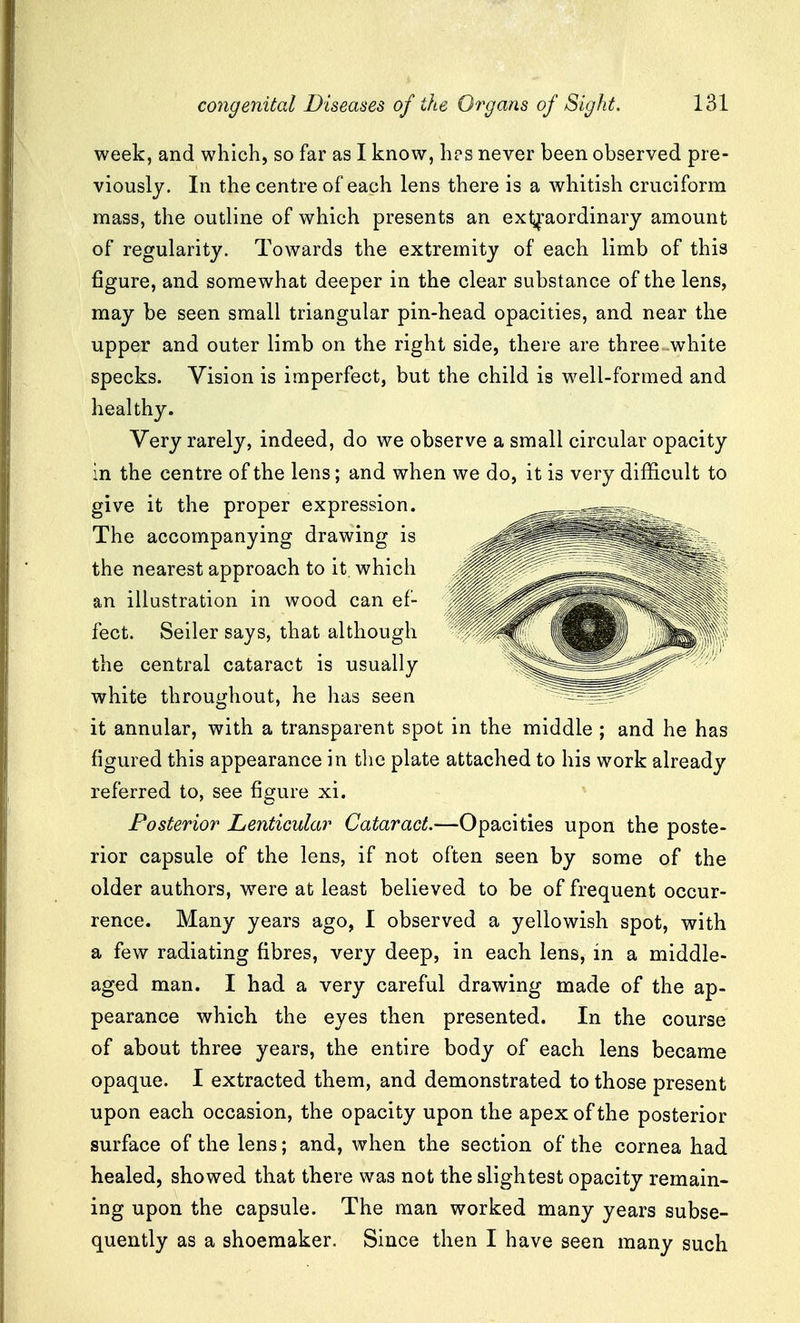 week, and which, so far as I know, hps never been observed pre- viously. In the centre of each lens there is a whitish cruciform mass, the outline of which presents an exl;^'aordinary amount of regularity. Towards the extremity of each limb of this figure, and somewhat deeper in the clear substance of the lens, may be seen small triangular pin-head opacities, and near the upper and outer limb on the right side, there are three white specks. Vision is imperfect, but the child is well-formed and healthy. Very rarely, indeed, do we observe a small circular opacity in the centre of the lens; and when we do, it is very difficult to give it the proper expression. The accompanying drawing is the nearest approach to it. which an illustration in wood can ef- fect. Seiler says, that although the central cataract is usually white throughout, he has seen it annular, with a transparent spot in the middle ; and he has figured this appearance in the plate attached to his work already referred to, see figure xi. ^ Posterior Lenticular Cataract.—Opacities upon the poste- rior capsule of the lens, if not often seen by some of the older authors, were at least believed to be of frequent occur- rence. Many years ago, I observed a yellowish spot, with a few radiating fibres, very deep, in each lens, in a middle- aged man. I had a very careful drawing made of the ap- pearance which the eyes then presented. In the course of about three years, the entire body of each lens became opaque. I extracted them, and demonstrated to those present upon each occasion, the opacity upon the apex of the posterior surface of the lens; and, when the section of the cornea had healed, showed that there was not the slightest opacity remain- ing upon the capsule. The man worked many years subse- quently as a shoemaker. Since then I have seen many such