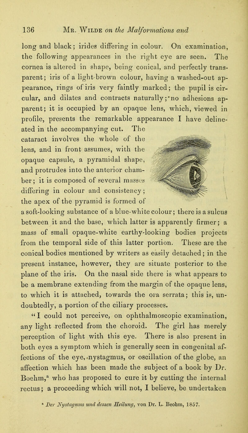 long and black; irides differing in colour. On examination, the following appearances in the right eye are seen. The cornea is altered in shape, being conical, and perfectly trans- parent; iris of a light-brown colour, having a washed-out ap- pearance, rings of iris very faintly marked; the pupil is cir- cular, and dilates and contracts naturally ;*no adhesions ap- parent; it is occupied by an opaque lens, which, viewed in profile, presents the remarkable appearance I have deline- ated in the accompanying cut. The cataract involves the whole of the lens, and in front assumes, with the opaque capsule, a pyramidal shape, and protrudes into the anterior cham- ber ; it is composed of several masscjs differing in colour and consistency; the apex of the pyramid is formed of a soft-looking substance of a blue-white colour; there is a sulcus between it and the base, which latter is apparently firmer; a mass of small opaque-white earthy-looking bodies projects from the temporal side of this latter portion. These are the conical bodies mentioned by writers as easily detached; in the present instance, however, they are situate posterior to the plane of the iris. On the nasal side there is what appears to be a membrane extending from the margin of the opaque lens, to which it is attached, towards the ora serrata; this is, un- doubtedly, a portion of the ciliary processes. I could not perceive, on ophthalmoscopic examination, any light reflected from the choroid. The girl has merely perception of light with this eye. There is also present in both eyes a symptom which is generally seen in congenital af- fections of the eye, nystagmus, or oscillation of the globe, an affection which has been made the subject of a book by Dr. Boehm,^ who has proposed to cure it by cutting the internal rectus; a proceeding which will not, I believe, be undertaken » Ber Nystagmus und dessen Heilung, von Dr. L. Beohm, 1857.