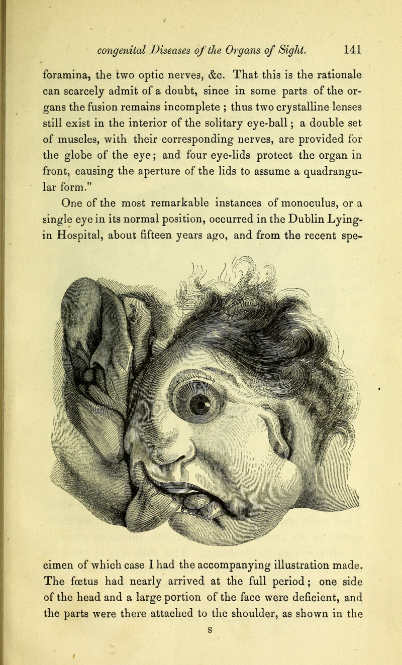 foramina, the two optic nerves, &c. That this is the rationale can scarcely admit of a doubt, since in some parts of the or- gans the fusion remains incomplete ; thus two crystalline lenses still exist in the interior of the solitary eye-ball; a double set of muscles, with their corresponding nerves, are provided for the globe of the eye; and four eye-lids protect the organ in front, causing the aperture of the lids to assume a quadrangu- lar form. One of the most remarkable instances of monoculus, or a single eye in its normal position, occurred in the Dublin Lying- in Hospital, about fifteen years ago, and from the recent spe- cimen of which case I had the accompanying illustration made. The foetus had nearly arrived at the full period; one side of the head and a large portion of the face were deficient, and the parts were there attached to the shoulder, as shown in the s