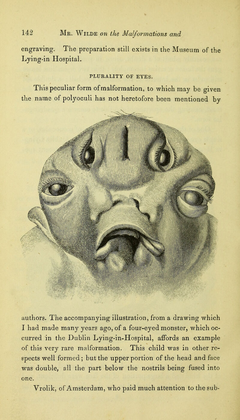 engraving. The preparation still exists in the Museum of the Lying-in Hospital. PLURALITY OF EYES. This peculiar form of malformation, to which may be given the name of polyoculi has not heretofore been mentioned by authors. The accompanying illustration, from a drawing which I had made many years ago, of a four-eyed monster, which oc- curred in the Dublin Lying-in-Hospital, affords an example of this very rare malformation. This child was in other re- spects well formed; but the upper portion of the head and face w^as double, all the part below the nostrils being fused into one. Vrolik, of Amsterdam, who paid much attention to the sub-