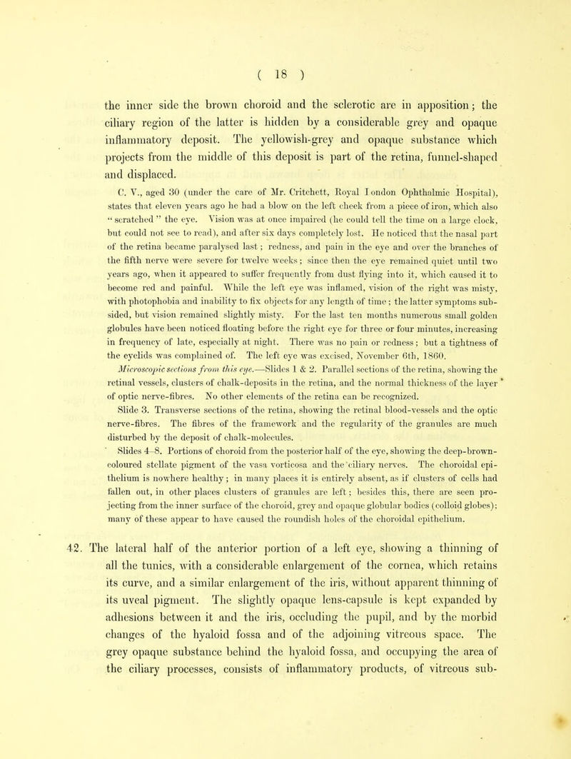 the inner side the brown choroid and the sclerotic are in apposition; the ciliary region of the latter is hidden by a considerable grey and opaque inflammatory deposit. The yellowish-grey and opaque substance which projects from the middle of this deposit is part of the retina, funnel-shaped and displaced. C. V., aged 30 (under the care of Mr. Critchett, Royal Iondon Ophthalmic Hospital), states that eleven years ago he had a blow on the left cheek from a piece of iron, which also  scratched  the eye. Vision was at once impaired (he coidd tell the time on a large clock, but could not see to read), and after six days completely lost. He noticed that the nasal part of the retina became paralysed last; redness, and pain in the eye and over the branches of the fifth nerve were severe for twelve weeks; since then the eye remained quiet until two years ago, when it appeared to suffer frequently from dust flying into it, which caused it to become red and painful. While the left eye was inflamed, vision of the right was misty, with photophobia and inability to fix objects for any length of time ; the latter symptoms sub- sided, but vision remained slightly niisty. For the last ten months numerous small golden globules have been noticed floating before the right eye for three or four minutes, increasing in frequency of late, especially at night. There was no pain or redness; but a tightness of the eyelids was complained of. The left eye was excised, November 6th, 1860. Microscopic sections from this eye.—Slides 1 & 2. Parallel sections of the retina, showing the retinal vessels, clusters of chalk-deposits in the retina, and the normal thickness of the layer * of optic nerve-fibres. No other elements of the retina can be recognized. Slide 3. Transverse sections of the retina, showing the retinal blood-vessels and the optic nerve-fibres. The fibres of the framework and the regularity of the granules are much disturbed by the deposit of chalk-molecules. . Slides 4-8. Portions of choroid from the posterior half of the eye, showing the deep-brown- coloured stellate pigment of the vasa vorticosa and the 'ciliary nerves. The choroidal epi- thelium is nowhere healthy; in many places it is entirely absent, as if clusters of cells had fallen out, in other places clusters of granules are left; besides this, there are seen pro- jecting from the inner surface of the choroid, grey and opaque globular bodies (colloid globes); many of these appear to have caused the roundish holes of the choroidal epithelium. The lateral half of the anterior portion of a left eye, showing a thinning of all the tunics, with a considerable enlargement of the cornea, which retains its curve, and a similar enlargement of the iris, without apparent thinning of its uveal pigment. The slightly opaque lens-capsule is kept expanded by adhesions between it and the iris, occluding the pupil, and by the morbid changes of the hyaloid fossa and of the adjoining vitreous space. The grey opaque substance behind the hyaloid fossa, and occupying the area of the ciliary processes, consists of inflammatory products, of vitreous sub-