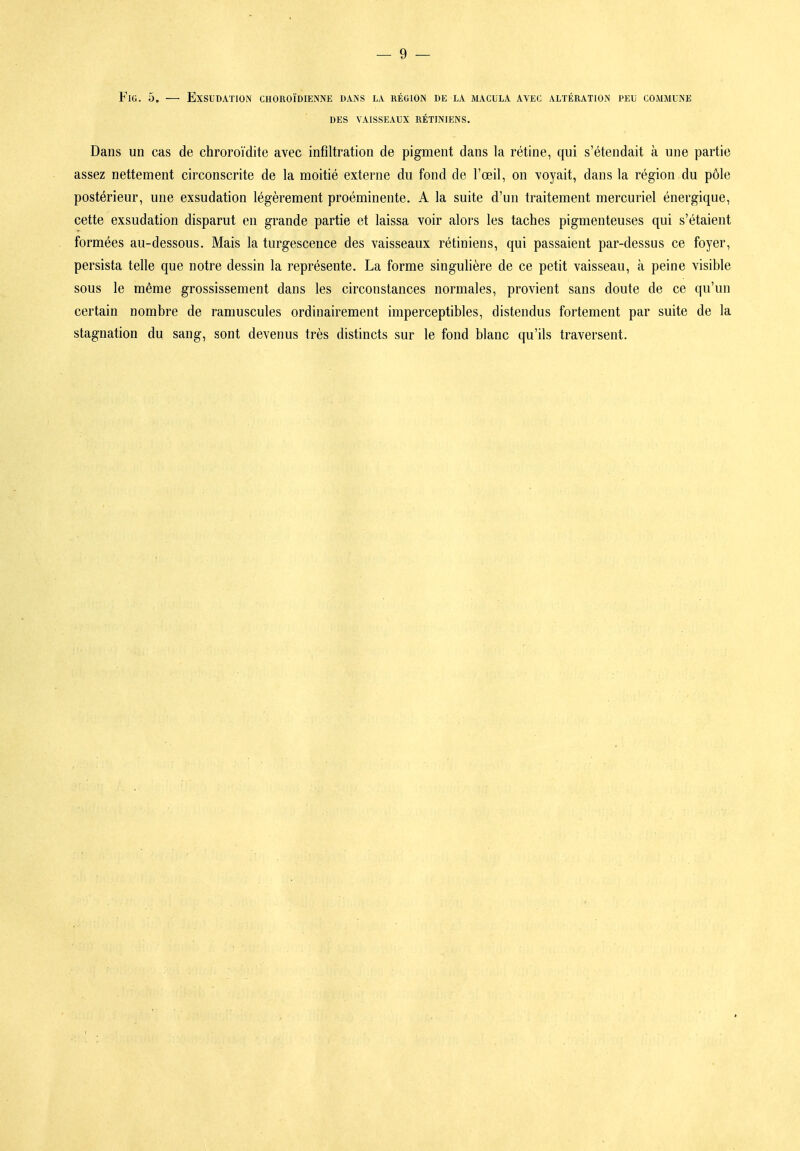 FiG. 5, — Exsudation choroïdienne dans la région de la macula avec altération peu commune DES VAISSEAUX RÉTINIENS. Dans un cas de chroroïdite avec infiltration de pigment dans la rétine, qui s'étendait à une partie assez nettement circonscrite de la moitié externe du fond de l'œil, on voyait, dans la région du pôle postérieur, une exsudation légèrement proéminente. A la suite d'un traitement mercuriel énergique, cette exsudation disparut en grande partie et laissa voir alors les taches pigmenteuses qui s'étaient formées au-dessous. Mais la turgescence des vaisseaux rétiniens, qui passaient par-dessus ce foyer, persista telle que notre dessin la représente. La forme singulière de ce petit vaisseau, à peine visible sous le même grossissement dans les circonstances normales, provient sans doute de ce qu'un certain nombre de ramuscules ordinairement imperceptibles, distendus fortement par suite de la stagnation du sang, sont devenus très distincts sur le fond blanc qu'ils traversent.