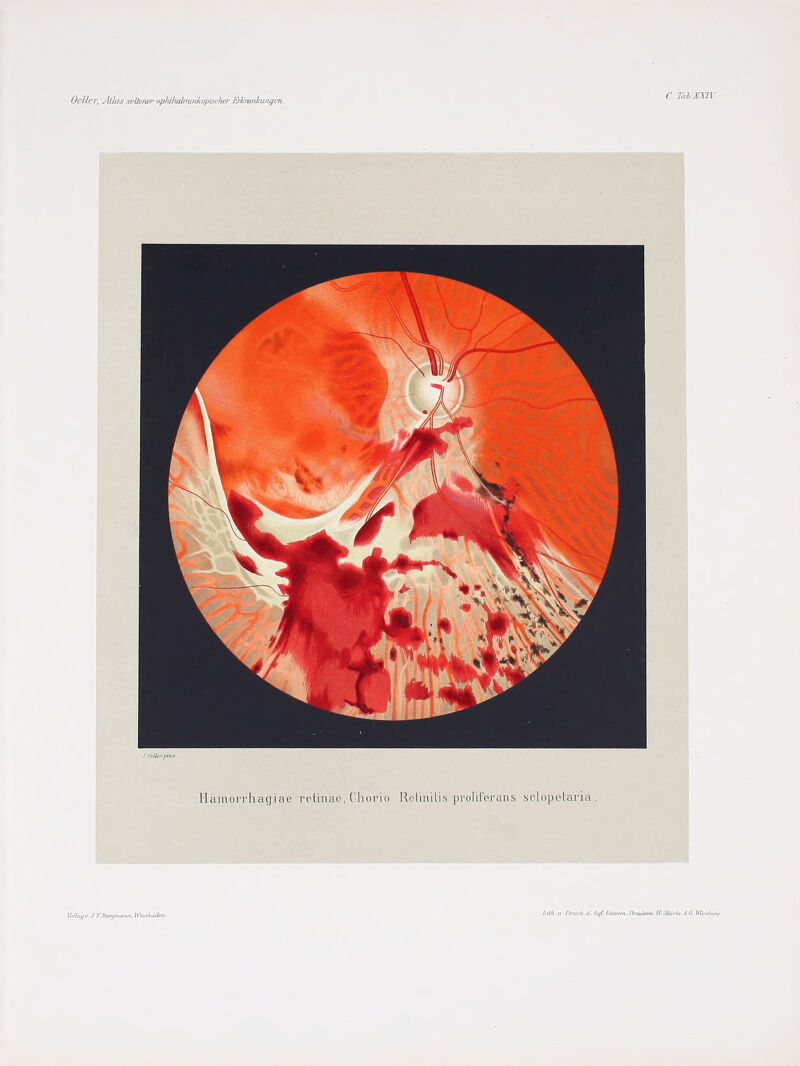 Ocllej; ^klas sellenep opIdlmlmoslcQpischer Erlcwnhiijigat,. C- TiOi XXiy- Haiuorrhagiae retinae, Chorio llctinilis proliforans sclopetaria . Vcrl/ujv J. FBen/mniin, Wlcshadxn..
