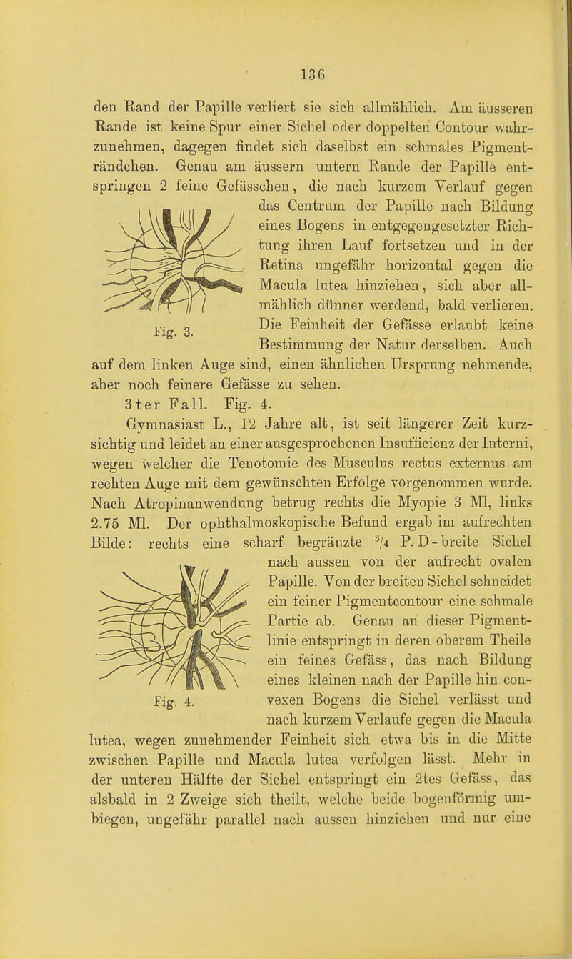 den Rand der Papille verliert sie sich allmählich. Am äusseren Rande ist keine Spur einer Sichel oder doppelten Contour wahr- zunehmen, dagegen findet sich daselbst ein schmales Pigment- rändchen. Genau am äussern untern Rande der Papille ent- springen 2 feine Gefässchen, die nach loirzem Verlauf gegen das Centrum der Papille nach Bildung eines Bogens in entgegengesetzter Rich- tung ihren Lauf fortsetzen und in der Retina ungefähr horizontal gegen die Macula lutea hinziehen, sich aber all- mählich dünner werdend, bald verlieren. Die Feinheit der Gefässe erlaubt keine Bestimmung der Natur derselben. Auch auf dem linken Auge sind, einen ähnlichen Ursprung nehmende, aber noch feinere Gefässe zu sehen. 3ter Fall. Fig. 4. Gymnasiast L., 12 Jahre alt, ist seit längerer Zeit kurz- sichtig und leidet an einer ausgesprochenen Insufficienz derinterni, wegen welcher die Tenotomie des Musculus rectus externus am rechten Auge mit dem gewünschten Erfolge vorgenommen wurde. Nach Atropinanwendung betrug rechts die Myopie 3 Ml, links 2.75 Ml. Der ophthalmoskopische Befund ergab im aufrechten Bilde: rechts eine scharf begränzte P.D-breite Sichel nach aussen von der aufrecht ovalen Papille. Von der breiten Sichel schneidet ein feiner Pigmentcontour eine schmale Partie ab. Genau an dieser Pigment- linie entspringt in deren oberem Theile ein feines Gefäss, das nach Bildung eines kleinen nach der Papille hin con- Fig. 4. vexen Bogens die Sichel verlässt und nach kurzem Verlaufe gegen die Macula lutea, wegen zunehmender Feinheit sich etwa bis in die Mitte zwischen Papille und Macula lutea verfolgen lässt. Mehr in der unteren Hälfte der Sichel entspriugt ein 2tes Gefäss, das alsbald in 2 Zweige sich theilt, welche beide bogenförmig um- biegen, ungefähr parallel nach aussen hinziehen und nur eine