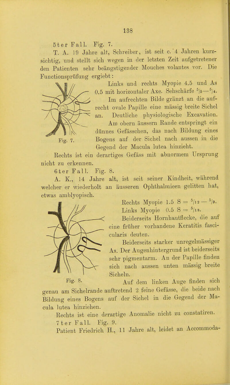 Fig. 7. ßter Fall. Fig. 7. T. A. 19 Jalire alt, Schreiber, ist seit c. 4 Jahren kurz- sichtig, uud stellt sich wegen in der letzten Zeit aufgetretener den Patienten sehr beängstigender Mouches volantes vor. Die Functionsprüfung ergiebt: Links und rechts Myopie 4.5 und As 0.5 mit horizontaler Axe. Sehschärfe ^le—^ji. Im aufrechten Bilde gränzt an die auf- recht ovale Papille eine massig breite Sichel an. Deutliche physiologische Excavation. Am obern äussern Rande entspringt ein dünnes Gefässchen, das nach Bildung eines Bogens auf der Sichel nach aussen in die Gegend der Macula lutea hinzieht. Rechts ist ein derartiges Gefäss mit abnormem Ursprung nicht zu erkennen. 6ter Fall. Fig. 8. A. K., 14 Jahre alt, ist seit seiner Kindheit, während welcher er Aviederholt an äusseren Ophthalmieen gelitten hat, etwas amblyopisch. Rechts Myopie 1.5 S - 5/i2 —^'g. Links Myopie 0.5 S = ^/is. Beiderseits Hornhautflecke, die auf eine früher vorhandene Keratitis fasci- cularis deuten. Beiderseits starker unregelmässiger As. Der Augenhintergrund ist beiderseits sehr pigmentarm. An der Papille finden sich nach aussen unten mässig breite Sicheln. Auf dem linken Auge finden sich genau am Sichelrande auftretend 2 feine Gefässe, die beide nach Bildung eines Bogens auf der Sichel in die Gegend der Ma- cula lutea hinziehen. Rechts ist eine derartige Anomalie nicht zu constatiren. 7ter Fall. Fig. 9. Patient Friedrich H., 11 Jahre alt, leidet an Accommoda- Fig. 8.