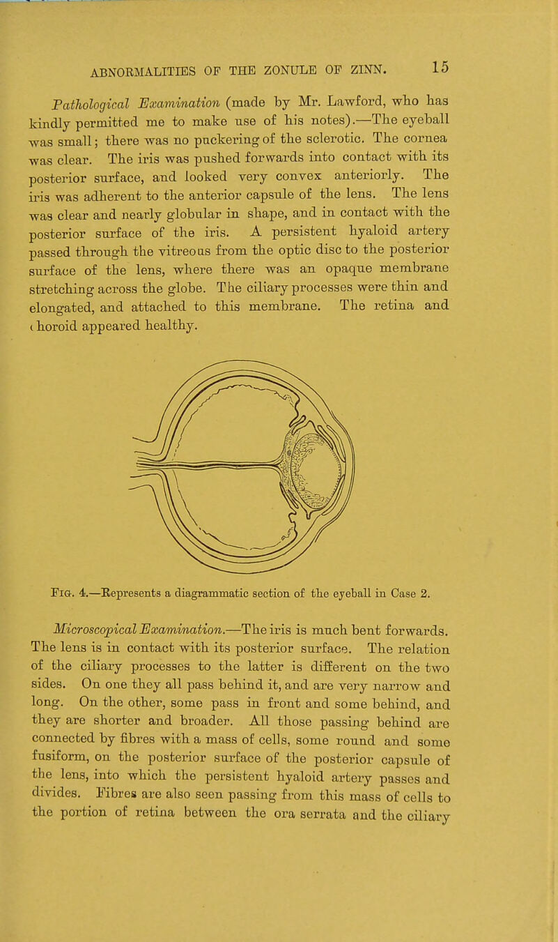 Pathological Examination (made by Mr. Lawford, who has kindly permitted me to make use of his notes).—The eyeball was small; there was no puckering of the sclerotic. The cornea was clear. The iris was pushed forw^ards into contact with its posterior surface, and looked very convex anteriorly. The iris was adherent to the anterior capsule of the lens. The lens was clear and nearly globular in shape, and in contact with the posterior surface of the iris. A persistent hyaloid artery passed through the vitreoas from the optic disc to the posterior surface of the lens, where there was an opaque membrane stretching across the globe. The ciliary processes were thin and elongated, and attached to this membrane. The retina and I horoid appeared healthy. Fig. 4.—Eepresents a diagrammatic section of tlie eyeball in Case 2. Microscopical Examination.—The iris is much bent forwards. The lens is in contact with its posterior surface. The relation of the ciliary processes to the latter is different on the two sides. On one they all pass behind it, and are very narrow and long. On the other, some pass in front and some behind, and they are shorter and broader. All those passing behind are connected by fibres with a mass of cells, some round and some fusiform, on the posterior surface of the posterior capsule o£ the lens, into which the persistent hyaloid artery passes and divides. Fibres are also seen passing from this mass of cells to the portion of retina between the ora serrata and the ciliary