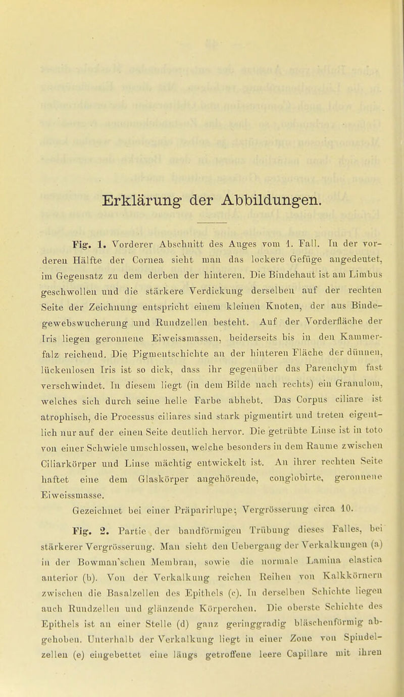 Erklärung der Abbildungen. Fig. 1. Vorderer Abschnitt des Auges yoiu 1. Fall. Tu der vor- dereu Hälfte der Cornea sieht man das lockere Gefüge angedeutet, im Gegensatz zu dem derben der hinteren. Die Bindehaut ist am Limbus geschwollen und die stärkere Verdickung derselben auf der rechten Seite der Zeichnung entspricht einem kleinen Knoten, der aus Binde- gewebswucherung und Rundzellen besteht. Auf der Vorderfläche der Iris liegen geronnene Eivveissmassen, beiderseits bis in den Kamnier- falz reichend. Die Pigmeutschichte an der hinteren Fläche der dünnen, lückenlosen Iris ist so dick, dass ihr gegenüber das Parencliym fast yerschwindet. In diesem liegt (in dem Bilde nach rechts) ein Granulom, welches sich durch seine helle Farbe abhebt. Das Corpus ciliare ist atrophisch, die Processus ciliares sind stark pigmentirt und treten eigent- lich nur auf der einen Seite deutlich hervor. Die getrübte Linse ist in toto von einer Schwiele umschlossen, welche besonders in dem Räume zwischen Ciliarkörper und Linse mächtig entwickelt ist. An ihrer rechten Seite haftet eine dem Glaskörper angehörende, conglobirte, geronnene Eiweissmasse. Gezeichnet bei einer Präparirlupe; Vergrösseruug circa 10. Fig-, 2. Partie der bandförmigen Trübung dieses Falles, bei' stärkerer Vergrösserung. Man sieht den Uebergang der Verkalkungen (a) in der Bovvman'sehen Membran, .sowie die normale Lamiua elastica anterior (b). Von der Verkalkung reichen Reihen von Kalkkörnern zwischen die Basalzellen des Epithels (c). In derselben Schichte liegen auch Rundzellen und glänzende Körperchen. Die oberste Schichte des Epithels ist an einer Stelle (d) ganz geringgradig bläschenförmig ab- gehoben. Unterhalb der Verkalkung liegt in einer Zone von Spindel- zelleu (e) eingebettet eine längs getroffene leere Capillare mit ihren