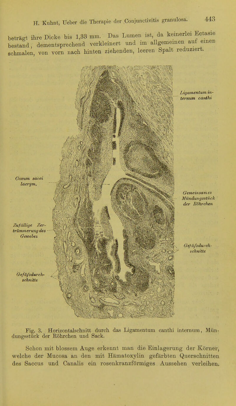beträgt ihre Dicke bis 1,33 mm. Das Lumen ist, da keinerlei Ectasie bestand, dementsprechend verkleinert und im allgemeinen auf einen schmalen, von vorn nach hinten ziehenden, leeren Spalt reduziert. Cavum sacci lacrym. Zufällige Zer- trümmerung des - Gewebes M Ligamentum in- ternum canthi Oefäfidurch- ^W&mSw schnitte Gemeinsames Mündungsstück der Röhrchen |||S\ Gejäfsdurch- schnitte Fig. 3. Horizontalschnitt durch das Ligamentum canthi internura, Mün- dungsstück der Eöhrchen imd Sack. Schon mit blossem Auge erkennt man die Einlagerung der Körner, welche der Mucosa an den mit Hämatoxylin gefärbten Querschnitten des Saccus und Canalis ein rosenkranzförmiges Aussehen verleihen.