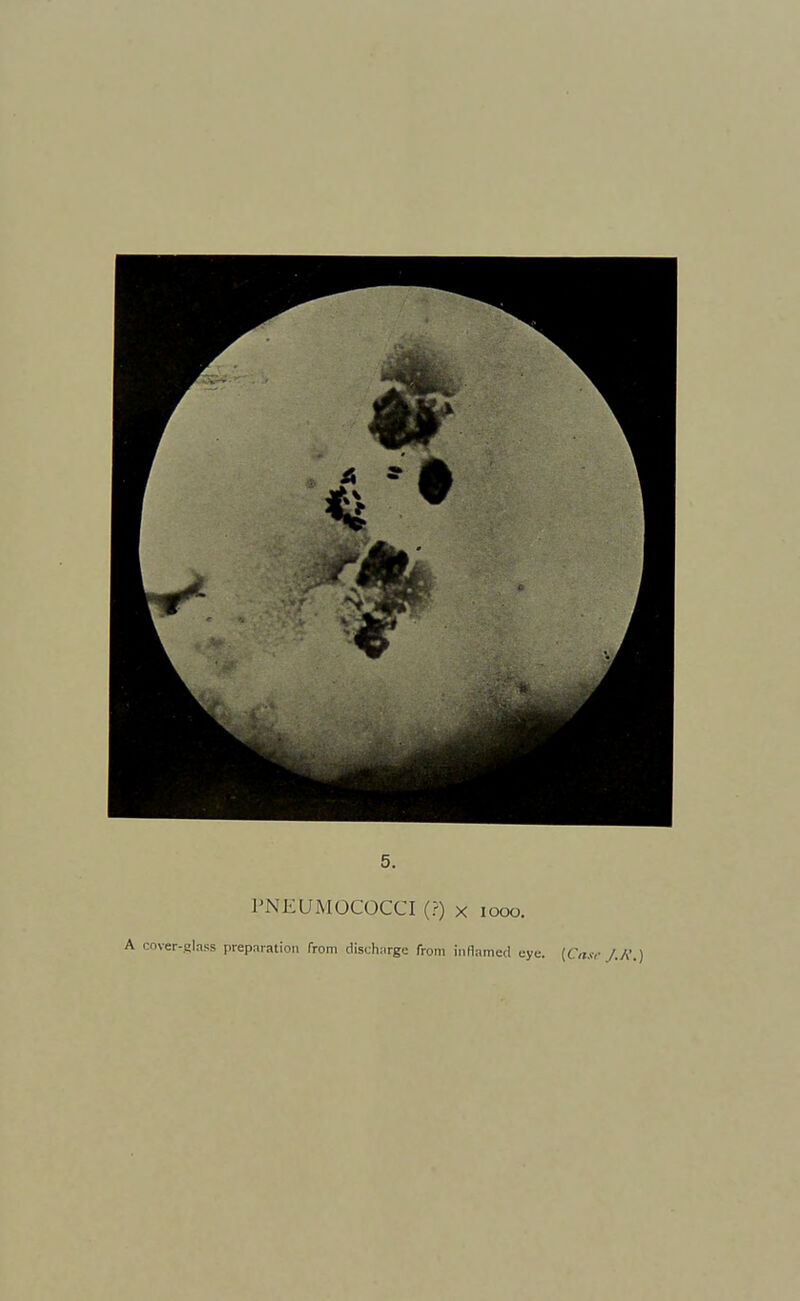 PNEUMOCOCCI (?) X looo. ler-filnss prepriratioii from discharge from inflamed e