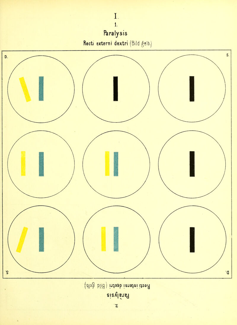 1. I^ralysis Recti externi dextri (Bild gelb.) (qjgP p]ig ) iJijxöp luja^ui ipay