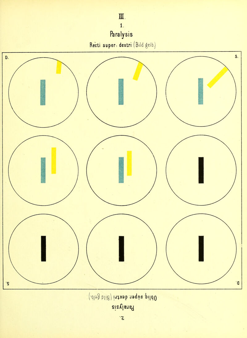 BI 1. Paralysis Recti super: dextri (Bild ^elb.) •qp^ piig] ij:i.x8p'jaclns LiiqQ