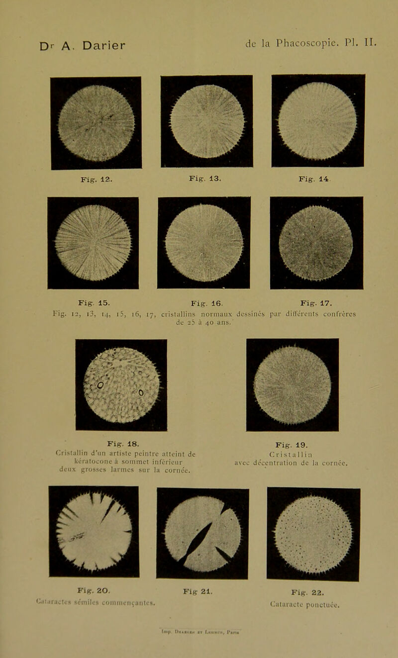 Qr A Darier de la Phacoscopie. PI. □ □□ Figr. 12. Fig. 13. Figr. 14. □ □□ Fig. 15. Fis. 16. Fiff. 17. rig. 12, i3, 14, i5, 16, 17, crislullins normaux dossincs pur diirereiits confrères de 25 à 40 ans. Fig. 18. Fig. 19. Ciisiallin d'un artiste peintre atteint de Cristallin kératocone à sommet inférieur avec déceniration de la cornée, deux grosses larmes sur la cornée. Fig. 20. Fig 21. Fig. 22. Oaiiiractc» scmilcs commençantes, Cutaracte ponctuée.