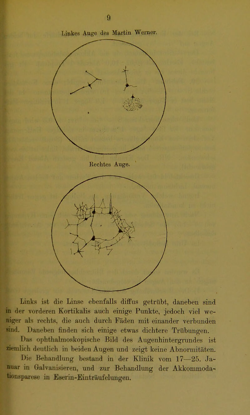 Linkes Auge des Martin Werner. Rechtes Auge. Links ist die Linse ebenfalls diffus getrübt, daneben sind in der vorderen Kortikalis auch einige Punkte, jedocb viel we- niger als rechts, die auch durch Fäden mit einander verbunden sind. Daneben finden sich einige etwas dichtere Trübungen. Das ophthalmoskopische Bild des Augenhintergrundes ist ziemlich deutlich in beiden Augen und zeigt keine Abnormitäten. Die Behandlung bestand in der Klinik vom 17—25. Ja- nuar in Galvanisieren, und zur Behandlung der Akkommoda- tionsparese in Eserin-Einträufelimgen.