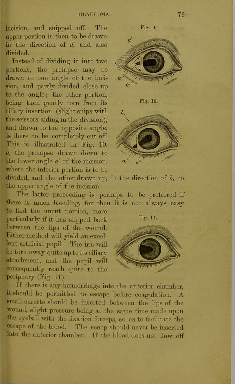 incision, and snipped off. The upper portion is then to be drawn in the direction of d, and also divided. Instead of dividing it into two portions, the prolapse may be drawn to one angle of the inci- sion, and partly divided close up to the angle; the other portion, being then gently torn from its ciliary insertion (slight snips with the scissors aiding in the division), and di'awn to the opposite angle, is there to be completely cut ofi. This is illustrated ia Fig. 10. a, the prolapse drawn down to the lower angle a of the iucision, where the inferior portion is to be divided, and the other drawn up, ia the direction of h, to the upper angle of the incision. The latter proceeding is perhaps to be preferred if there is much bleeding, for then it is not always easy to find the uncut portion, more particularly if it has slipped back between the lips of the wound. Either method wdll yield an excel- lent artificial pupil. The iris will be torn away quite up to its ciHary attachment, and the pupil will consequently reach quite to the periphery (Fig. 11). If there is any haemorrhage into the anterior chamber, it shoiild be permitted to escape before coagulation. A small curette should be inserted between the lips of the wound, slight pressure being at the same time made upon the eyeball \\dth the fixation forceps, so as to facihtate the escape of the blood. The scoop should never be inserted into the anterior chamber. If the 1)1 ood does not fl.ow off Fig. 9. Fig. 10. I' ^