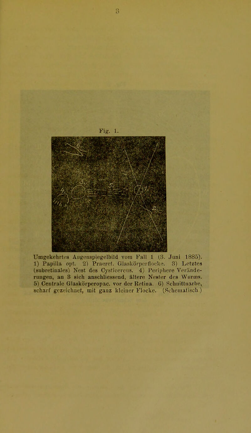 Umgekehrtes Augenspiegelbild vom Fall 1 (3. Juni 1885). 1) Papilla ojit. 2) Praeret. Glaskörperflocke. 3) Letztes (Bubretinales) Nest des Cysticercus. 4) Periphere Verände- rungen, an 3 sich anschliessend, ältere Nester des Wurms. 5) Centrale (jlla.skörperopac. vor der Retina. G) Schnittnarbe, scharf gezeichnet, mit ganz kleiner Flocke. (Rchetnatisch)