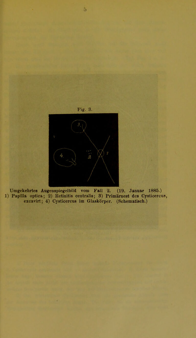 Umgekehrtes Augenspiegelbild vom Fall 2. (19. Januar 1885.) 1) Papilla optica; 2) Retinitis centralis; 8) Primärnest des Cysticercus, excavirt; 4) Cysticercus im Glaskörper. (Schematisch.)