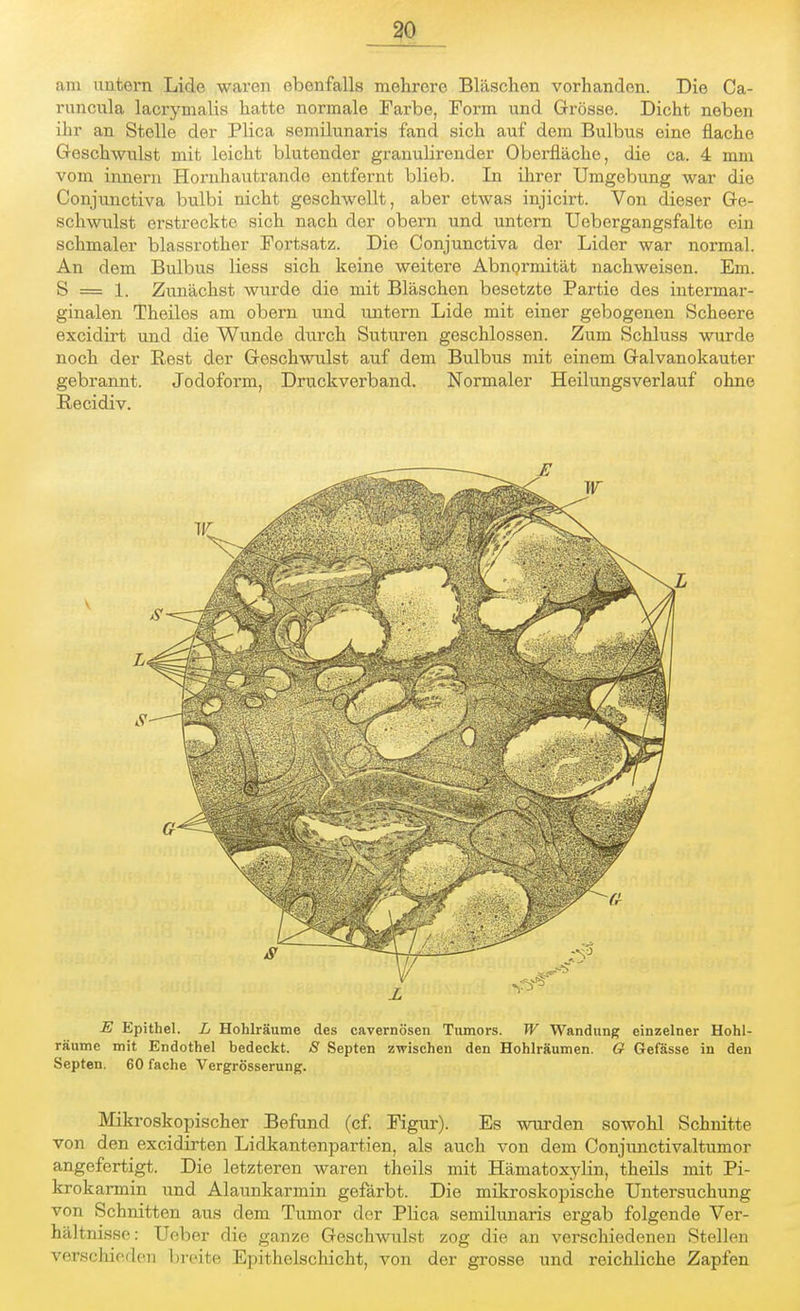 am untern Lide waren ebenfalls mehrere Bläschen vorhanden. Die Ca- runcula lacrymalis hatte normale Farbe, Form und Grösse. Dicht neben ihr an Stelle der Plica semilunaris fand sich auf dem Bulbus eine flache Geschwulst mit leicht blutender granulirender Oberfläche, die ca. 4 mm vom innem Hornhautrando entfernt blieb. In ihrer Umgebung war die Conjunctiva bulbi nicht geschwellt, aber etwas injicirt. Von dieser Ge- schwulst erstreckte sich nach der obern und untern Uebergangsfalte ein schmaler blassrother Fortsatz. Die Conjunctiva der Lider war normal. An dem Bulbus Hess sich keine weitere Abnormität nachweisen. Em. S = 1. Zunächst wurde die mit Bläschen besetzte Partie des intermar- ginalen Theiles am obern und untern Lide mit einer gebogenen Scheere excidirt und die Wunde durch Suturen geschlossen. Zum Schluss wurde noch der Rest der Geschwulst auf dem Bulbus mit einem Galvanokauter gebrannt. Jodoform, Druckverband. Normaler Heilungsverlauf ohne Recidiv. V E Epithel. L Hohlräume des cavernösen Tumors. W Wandung einzelner Hohl- räume mit Endothel bedeckt. S Septen zwischen den Hohlräumen. O Gefässe in den Septen. 60 fache Vergrößerung. Mikroskopischer Befund (cf. Figur). Es wurden sowohl Schnitte von den excidirten Lidkantenpartien, als auch von dem Conjunctivaltumor angefertigt. Die letzteren waren theils mit Hämatoxylin, theils mit Pi- krokarmin und Alaunkarmin gefärbt. Die mikroskopische Untersuchung von Schnitten aus dem Tumor der Plica semilunaris ergab folgende Ver- hältnisse: Ueber die ganze Geschwulst zog die an verschiedenen Stellen verschiede?) breite Epithelschicht, von der grosse und reichliche Zapfen