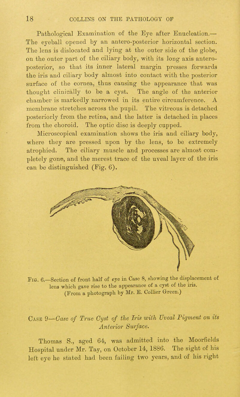 Pathological Examination of the Eye after Enucleation.— The eyeball opened by an antero-posterior horizontal section. The lens is dislocated and lying at the outer side of the globe, on the outer part of the ciliary body, with its long axis antero- posterior, so that its inner lateral margin presses forwards the iris and ciliary body almost into contact with the posterior surface of the cornea, thus causing the appearance that was thought clinically to be a cyst. The angle of the anterior chamber is markedly narrowed in its entire circumference. A membrane stretches across the pupil. The vitreous is detached posteriorly from the retina, and the latter is detached in places from the choroid. The optic disc is deeply cupped. Microscopical examination shows the iris and ciliary body, where they are pressed upon by the lens, to be extremely atrophied. The ciliary muscle and processes are almost com- pletely gone, and the merest trace of the uveal layer of the iris can be distinguished (Fig. 6). Fio. 6.—Section of front half of eye in Case 8, showing the displacement of lens which gave rise to the appearance of a cyst of the iris. (From a photograph by Mr. E. Collier Green.) Case 9—Case of True Cyst of the Iris with Uveal Pigment on its Anterior Surface. Thomas S., aged 64, was admitted into the Moorfields Hospital under Mr. Tay, on October 14, 1886. The sight of his left eye he stated had been failing two years, and of his right