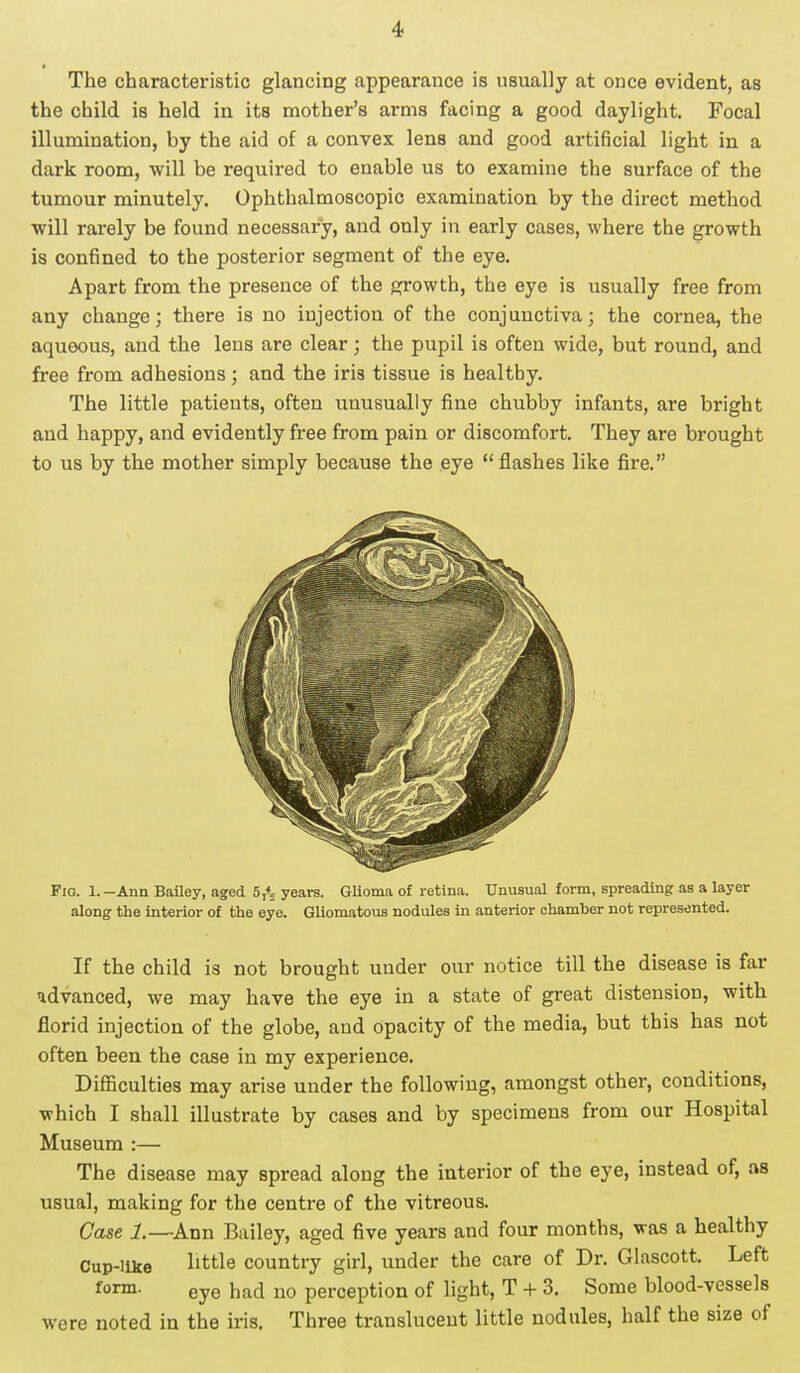 The characteristic glancing appearance is usually at once evident, as the child is held in its mother's arms facing a good daylight. Focal illumination, by the aid of a convex lens and good artificial light in a dark room, will be required to enable us to examine the surface of the tumour minutely. Ophthalmoscopic examination by the direct method will rarely be found necessary, and only in early cases, where the growth is confined to the posterior segment of the eye. Apart from the presence of the growth, the eye is usually free from any change; there is no injection of the conjunctiva; the cornea, the aqueous, and the lens are clear; the pupil is often wide, but round, and free from adhesions; and the iris tissue is healthy. The little patients, often unusually fine chubby infants, are bright and happy, and evidently free from pain or discomfort. They are brought to us by the mother simply because the eye flashes like fire. Fig. 1. -Ann Bailey, aged 5,45 years. Glioma of retina. Unusual form, spreading as a layer along the interior of the eye. Gliomatous nodules in anterior chamber not represented. If the child is not brought under our notice till the disease is far advanced, we may have the eye in a state of great distension, with florid injection of the globe, and opacity of the media, but this has not often been the case in my experience. Difficulties may arise under the following, amongst other, conditions, which I shall illustrate by cases and by specimens from our Hospital Museum :— The disease may spread along the interior of the eye, instead of, as usual, making for the centre of the vitreous. Case 1.—Ann Bailey, aged five years and four months, was a healthy Cup-like little country girl, under the care of Dr. Glascott. Left form. eye had no perception of light, T + 3. Some blood-vessels were noted in the iris. Three translucent little nodules, half the size of