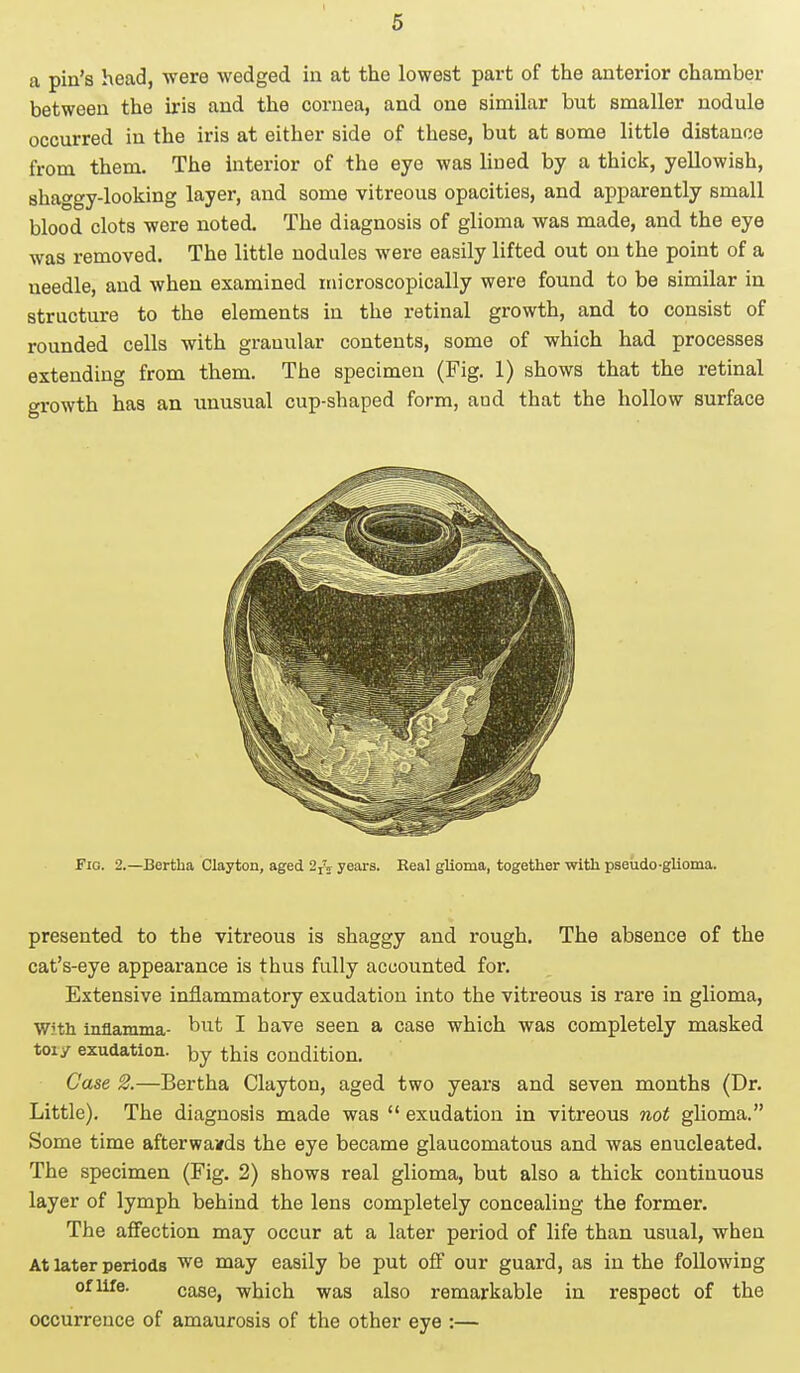 a pin's head, were wedged in at the lowest part of the anterior chamber between the iris and the cornea, and one similar but smaller nodule occurred in the iris at either side of these, but at some little distance from them. The interior of the eye was lined by a thick, yellowish, shaggy-looking layer, and some vitreous opacities, and apparently small blood clots were noted. The diagnosis of glioma was made, and the eye was removed. The little nodules were easily lifted out on the point of a needle, and when examined microscopically were found to be similar in structure to the elements in the retinal growth, and to consist of rounded cells with granular contents, some of which had processes extending from them. The specimen (Fig. 1) shows that the retinal growth has an unusual cup-shaped form, aud that the hollow surface Fig. 2.—Bertha Clayton, aged 2rV years. Real glioma, together with pseudo-glioma. presented to the vitreous is shaggy and rough. The absence of the cat's-eye appearance is thus fully accounted for. Extensive inflammatory exudation into the vitreous is rare in glioma, With Mamma- but I have seen a case which was completely masked toiy exudation, by this condition. Case 2.—Bertha Clayton, aged two years and seven months (Dr. Little). The diagnosis made was  exudation in vitreous not glioma. Some time afterwards the eye became glaucomatous and was enucleated. The specimen (Fig. 2) shows real glioma, but also a thick continuous layer of lymph behind the lens completely concealing the former. The affection may occur at a later period of life than usual, when At later periods we may easily be put off our guard, as in the following of life. casej -which wa8 aiso remarkable in respect of the occurrence of amaurosis of the other eye :—