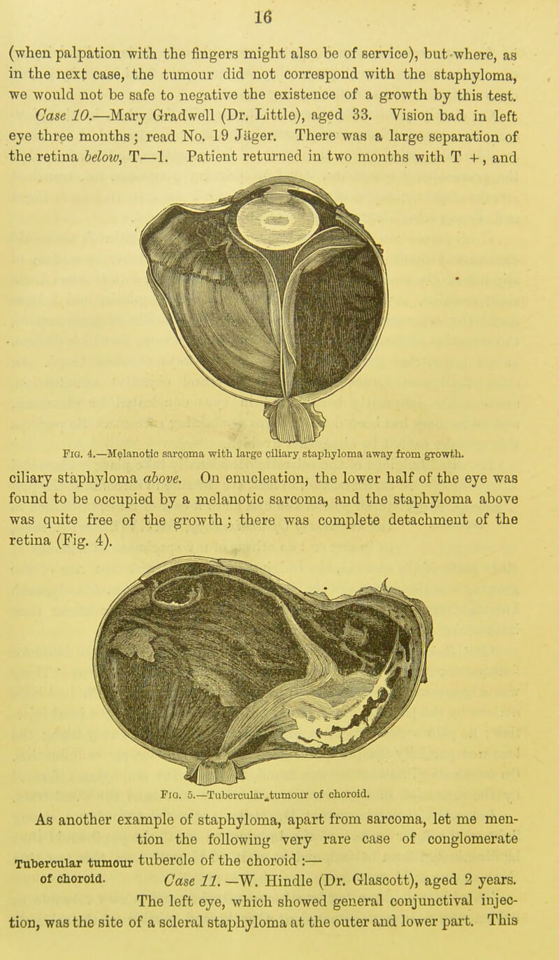 (when palpation with the fingers might also be of service), but-where, as in the next case, the tumour did not correspond with the staphyloma, we would not be safe to negative the existence of a growth by this test. Case 10.—Mary Gradwell (Dr. Little), aged 33. Vision bad in left eye three months; read No. 19 Jager. There was a large separation of the retina below, T—1. Patient returned in two months with T +, and Fig. 4.—Melanotic sarcoma with large ciliary staphyloma away from growth. ciliary staphyloma above. On enucleation, the lower half of the eye was found to be occupied by a melanotic sarcoma, and the staphyloma above was quite free of the growth; there was complete detachment of the retina (Fig. 4). Fio. 5.—Tubcrcular.tumour of choroid. As another example of staphyloma, apart from sarcoma, let me men- tion the following very rare case of conglomerate Tubercular tumour tubercle of the choroid :— of choroid. Case 11. —W. Hindle (Dr. Glascott), aged 2 years. The left eye, which showed general conjunctival injec- tion, was the site of a scleral staphyloma at the outer and lower part. This