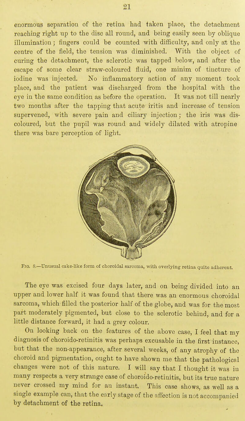 enormous separation of the retina had taken place, the detachment reaching right up to the disc all round, and being easily seen by oblique illumination; fingers could be counted with difficulty, and only at the centre of the field, the tension was diminished. With the object of curing the detachment, the sclerotic was tapped below, and after tbe escape of some clear straw-coloured fluid, one minim of tincture of iodine was injected. No inflammatory action of any moment took place, and the patient was discharged from the hospital with the eye in the same condition as before the operation. It was not till nearly two months after the tapping that acute iritis and increase of tension supervened, with severe pain and ciliary injection; the iris was dis- coloured, but the pupil was round and widely dilated with atropine there was bare perception of light. Fjo. S.—Unusual cake-like form of choroidal sarcoma, with overlying retina quite adherent. The eye was excised four days later, and on being divided into an upper and lower half it was found that there was an enormous choroidal sarcoma, which filled the posterior half of the globe, and was for the most part moderately pigmented, but close to the sclerotic behind, and for a little distance forward, it had a grey colour. On looking back on the features of the above case, I feel that my diagnosis of choroido-retinitis was perhaps excusable in the first instance, but that the non-appearance, after several weeks, of any atrophy of the choroid and pigmentation, ought to have shown me that the pathological changes were not of this nature. I will say that I thought it was in many respects a very strange case of choroido-retinitis, but its true nature never crossed my mind for an instant. This case shows, as well as a single example can, that the enrly stage of the affection is not accompanied by detachment of the retina.