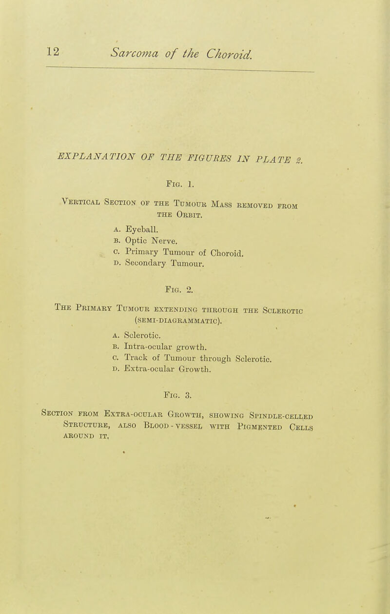 EXPLANATION OF THE FIGURES IN PLATE 2. Fig. 1. Vertical Section of the Tumouk Mass removed from THE Orbit. A. Eyeball. B. Optic Nerve. C. Primary Tumour of Choroid. D. Secondary Tumour. Fig. 2. The Primary Tumour extending through the Sclerotic (semi-diagrammatic). A. Sclerotic. B. Intra-ocular growth. c. Track of Tumour through Sclerotic. D. Extra-ocular Growth. Fig. 3. Section from Extra-ocular Growth, showing Spindle-celled Structure, also Blood-vessel with Pigmented Cells around it,