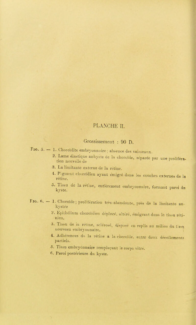 PLANCHE II. Grossissement : 90 D. Fig. 5. — 1. Choroidite embryonnaire ; absence des vaisseaux. 2. Lame élastique anhyste de la choroïde, séparée par une proliféra- non nouvelle de 3. La limitante externe de la rétine. 4. Pigment choroïdien ayant émigré dans les couches externes de ia retme. 5'kÏeU de la rétîe' entifevmiCUt 01»,J1T°»Hire, tonnant paroi à» Fig. fi. - 1 Choroïde; prolifération très.-aboiidaute, prés de la limitante an- kystée El'itl,élium choroïdien déplacé, altéré, émigrant dans le tissu réti- nien. 3. Tissu de ia rétine, sclérosé, disposé eu replis au milieu du tssii nouveau embryonnaire. 4. Adhérences de la rétine a la choroïde, entre deux décollement-, partiels. 5. Tissu embryonnaire remplaçant ie corps vitré, fi. Paroi postérieure du kyste.