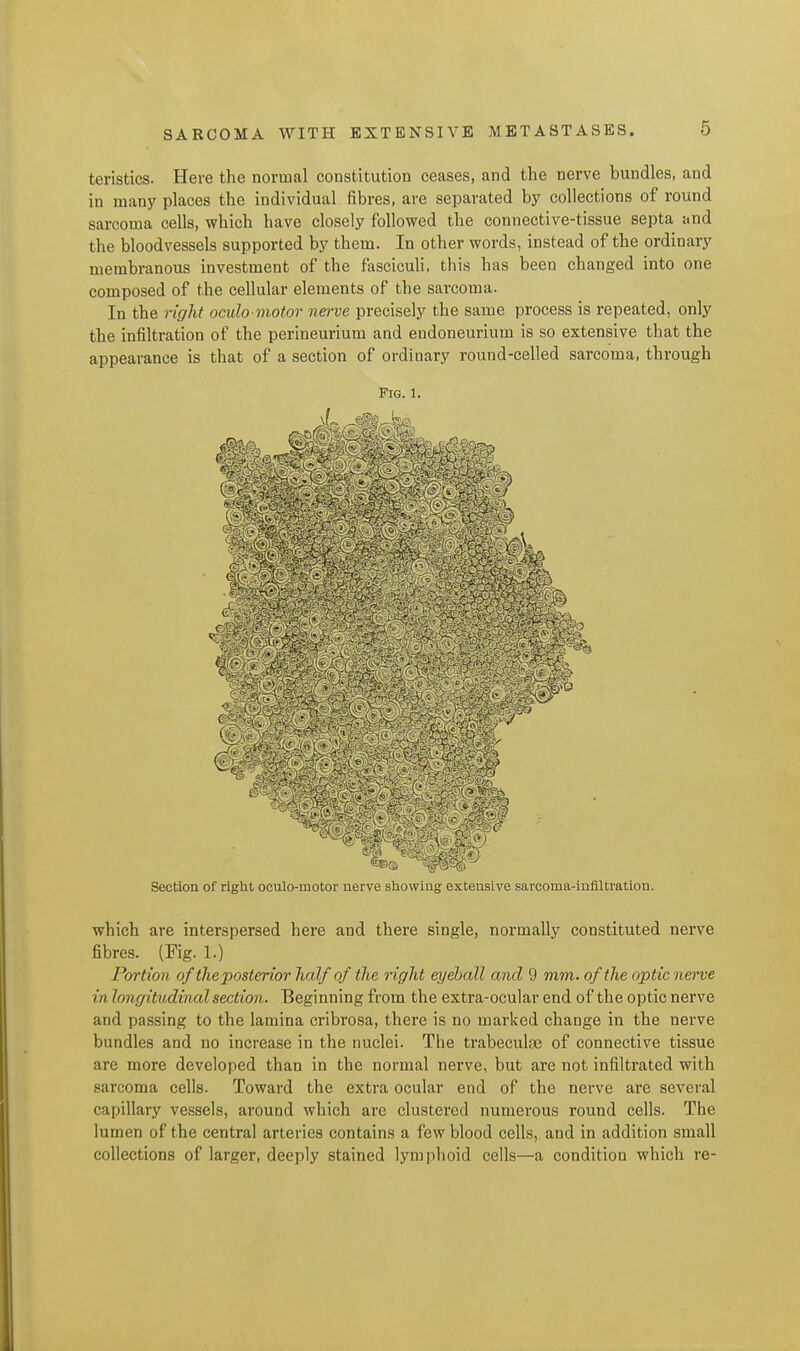 teristics. Here the normal constitution ceases, and the nerve bundles, and in many places the individual fibres, are separated by collections of round sarcoma cells, which have closely followed the connective-tissue septa and the bloodvessels supported by them. In other words, instead of the ordinary membranous investment of the fasciculi, this has been changed into one composed of the cellular elements of the sarcoma. In the right oculo motor nerve precisely the same process is repeated, only the infiltration of the perineurium and endoneurium is so extensive that the appearance is that of a section of ordinary round-celled sarcoma, through Pig. 1. Section of right oculo-motor nerve showing extensive sarcoma-infiltration. which are interspersed here and there single, normally constituted nerve fibres. (Fig. 1.) Portion of the posterior half of the right eyeball and 9 mm. of the optic nerve in longitudinal section. Beginning from the extra-ocular end of the optic nerve and passing to the lamina cribrosa, there is no marked change in the nerve bundles and no increase in the nuclei. The trabeculge of connective tissue are more developed than in the normal nerve, but are not infiltrated with sarcoma cells. Toward the extra ocular end of the nerve are several capillary vessels, around which are clustered numerous round cells. The lumen of the central arteries contains a few blood cells, and in addition small collections of larger, deeply stained lymphoid cells—a condition which re-