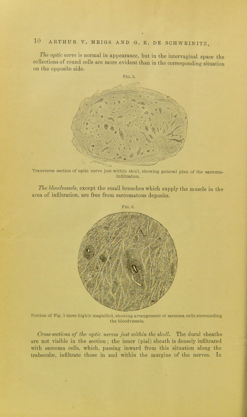 The optic nerve is normal in appearance, but in the intervaginal space the collections of round cells are more evident than in the corresponding situation on the opposite side. Fig. 5. ■I* Transverse section of optic nerve just witlihi skull, showing general plan of the sarcoma- infiltration. . The bloodvessels, except the small branches which supply the muscle in the area of infiltration, are free from sarcomatous deposits. Fig. 6. V-.'-:- HW'ii ffi* , Portion of Fig. 5 more highly maguiiiuu, .-siiuumg arrangement ot sarcoma cells surrounding the bloodvessels. Cross-sections of the optic nerves just within the skull. The dural sheaths are not visible in the section ; the inner (pial) sheath is densely infiltrated with sarcoma cells, which, passing inward from this situation along the trabeculas, infiltrate those in and within the margins of the nerves. In