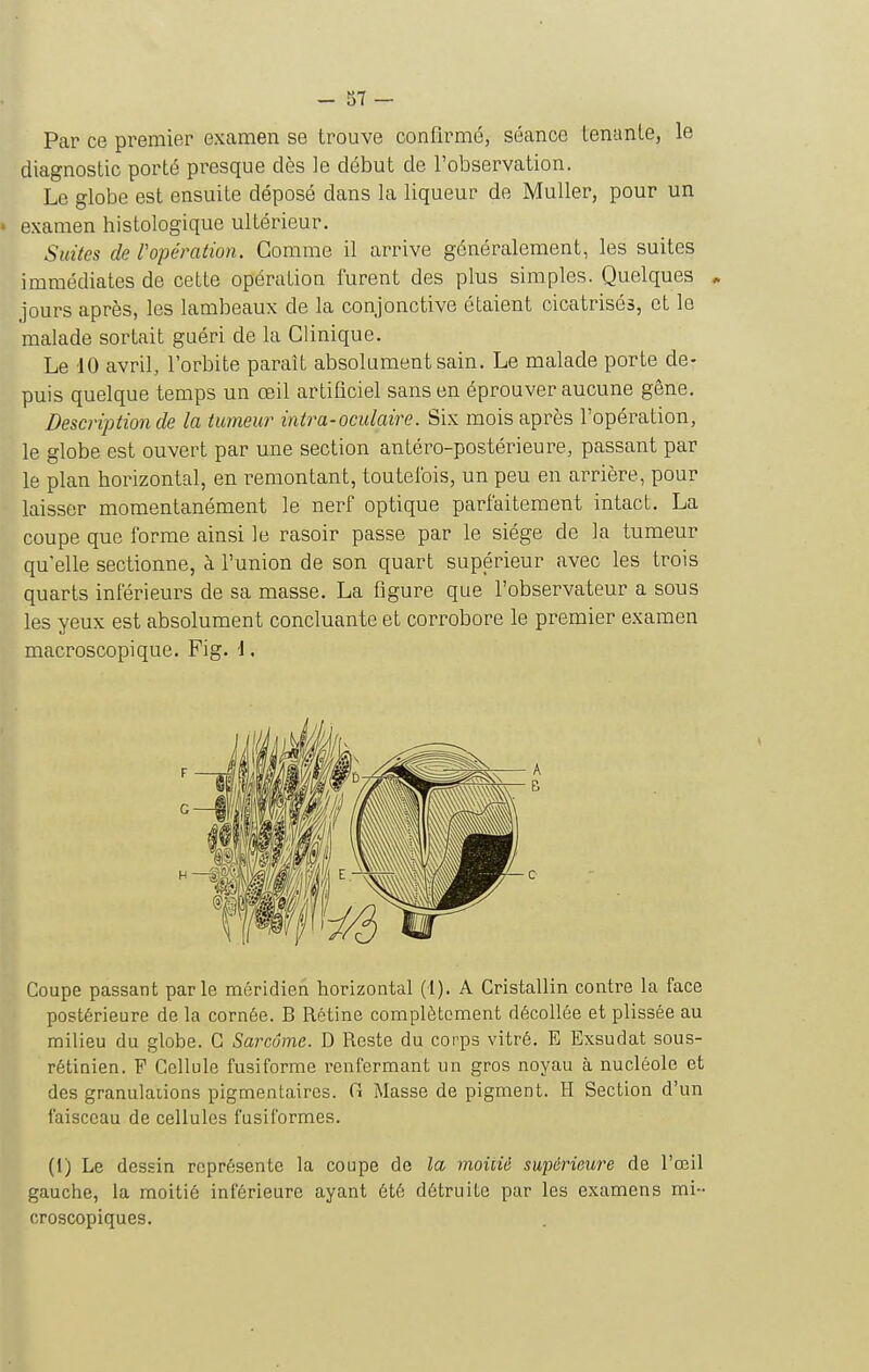 Par ce premier examen se trouve confirmé, séance tenante, le diagnostic porté presque dès ]e début de l'observation. Le globe est ensuite déposé dans la liqueur de Muller, pour un ' examen histologique ultérieur. Suites de ropération. Gomme il arrive généralement, les suites immédiates de cette opération furent des plus simples. Quelques • jours après, les lambeaux de la conjonctive étaient cicatrisés, et le malade sortait guéri de la Clinique. Le 10 avril, l'orbite paraît absolument sain. Le malade porte de- puis quelque temps un œil artiliciel sans en éprouver aucune gêne. Description de la tumeur intra-oculaire. Six mois après l'opération, le globe est ouvert par une section antéro-postérieure, passant par le plan horizontal, en remontant, toutefois, un peu en arrière, pour laisser momentanément le nerf optique parfaitement intact. La coupe que forme ainsi ]e rasoir passe par le siège de la tumeur qu'elle sectionne, à l'union de son quart supérieur avec les trois quarts inférieurs de sa masse. La figure que l'observateur a sous les yeux est absolument concluante et corrobore le premier examen macroscopique. Fig. 1. Coupe passant parle méridien horizontal (i). A Cristallin contre la face postérieure de la cornée. B Rétine complètement décollée et plissée au milieu du globe. C Sarcome. D Reste du corps vitré. B Exsudât sous- rétinien. F Cellule fusiforme renfermant un gros noyau à nucléole et des granulations pigmentaires. G Masse de pigment. H Section d'un faisceau de cellules fusiformes. (t) Le dessin représente la coupe de la moitié supérieure de l'œil gauche, la moitié inférieure ayant été détruite par les examens mi- croscopiques.