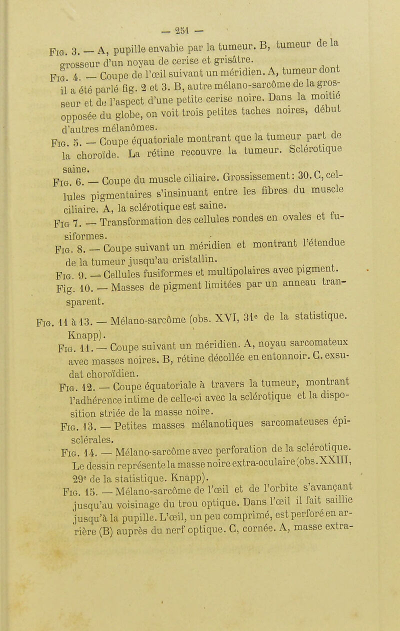 FiG. 3. - A, pupille envahie par la tumeur. B, Lumeur de la grosseur d'un noyau de cerise et grisâtre. 4 _ Coupe de l'œil suivant un méridien. A, tumeur dont il a été parlé ûg. 2 et 3. B, autre mélano-sarcôme de la gros- seur et de l'aspect d'une petite cerise noire. Dans la moitié opposée du globe, on voit trois petites taches noires, début d'autres mélanômes. FiG 5 - Coupe équatoriale montrant que la tumeur part de là choroïde. La rétine recouvre la tumeur. Sclérotique ^1^7'— Coupe du muscle ciliaire. Grossissement: 30.C, cel- lules pigmentaires s'insinuant entre les fibres du muscle ciliaire. A, la sclérotique est saine. FiG 7. - Transformation des cellules rondes en ovales et iu- sifoi*iii6s PiG. 8. - Coupe suivant un méridien et montrant l'étendue de la tumeur jusqu'au cristallin. FiG 9 Cellules fusiformes et multipolaires avec pigment. Fig. 10. — Masses de pigment limitées par un anneau tran- sparent. PiG. 11 à 13. - Mélano-sarcôme (obs. XVI, 31c de la statistique. Knapp). , FiG 11 — Coupe suivant un méridien. A, noyau sarcomateux avec masses noires. B, rétine décollée en entonnoir. C. exsu- dât choroïdien. Fig. 12. — Coupe équatoriale à travers la tumeur, montrant l'adhérence intime de celle-ci avec la sclérotique et la dispo- sition striée de la masse noire. Fig. 13.— Petites masses mélanotiques sarcomateuses épi- FiG. U. — Mélano-sarcôme avec perforation de la sclérotique. Le dessin'représen te la masse noire extra-oculaire ^obs. XXIII, 29^ de la statistique. Knapp). Fig. 15. — Mélano-sarcôme de l'œil et de l'orbite s'avançant jusqu'au voisinage du trou optique. Dans l'œil il fait sailbe jusqu'à la pupille. L'œil, un peu comprimé, est perforé en ar- rière (B) auprès du nerf optique. C, cornée. A, masse extra-