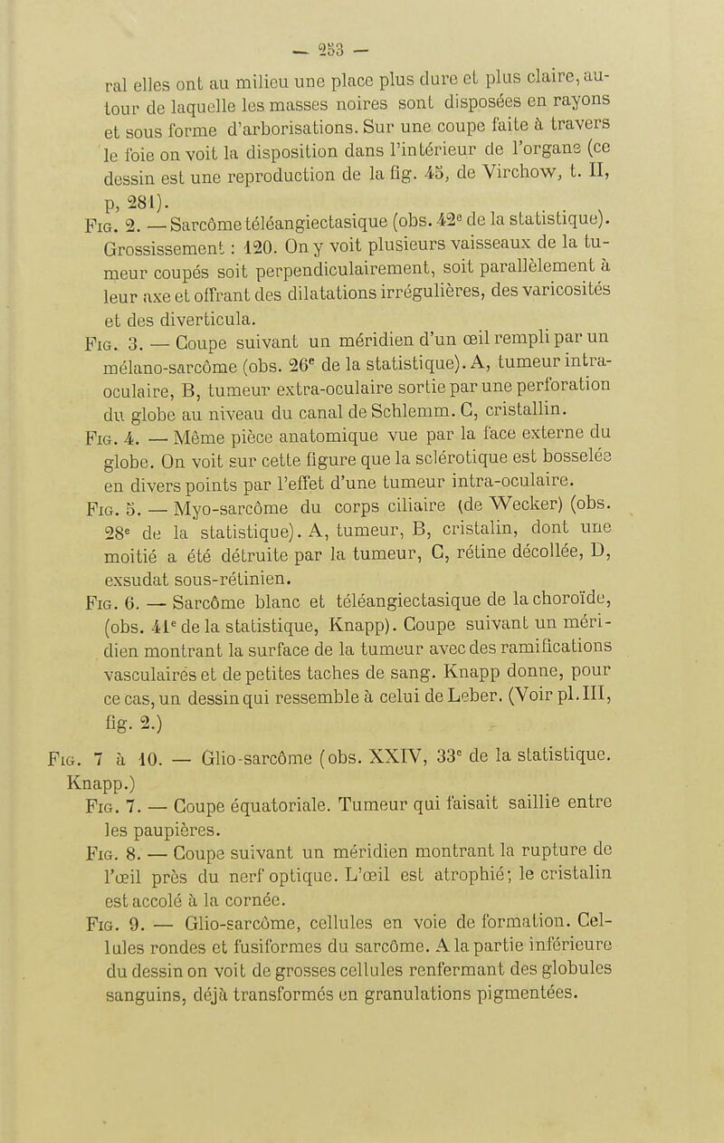 ^ 553 - ral elJes ont eau milieu une place plus dure et plus claire, au- tour de laquelle les masses noires sont disposées en rayons et sous forme d'arborisations. Sur une coupe faite à travers le foie on voit la disposition dans l'intérieur de l'organs (ce dessin est une reproduction de la fig. 45, de Virchow, t. II, P, 281). . . ^ PiG. 2. — Sarcome téléangiectasique (obs. 42 de la statistique). Grossissement : 120. On y voit plusieurs vaisseaux de la tu- meur coupés soit perpendiculairement, soit parallèlement à leur axe et offrant des dilatations irrégulières, des varicosités et des diverticula. Fig. 3.— Coupe suivant un méridien d'un œil rempli par un mélano-sarcôme (obs. 26« de la statistique). A, tumeur intra- oculaire, B, tumeur extra-oculaire sortie par une perforation du globe au niveau du canal de Schlemm. G, cristallin. FiG. 4. — Même pièce anatomique vue par la face externe du globe. On voit sur cette figure que la sclérotique est bosselée en divers points par l'effet d'une tumeur intra-oculaire. PiG. S. — Myo-sarcôme du corps ciliaire (de Wecker) (obs. 28« de la statistique). A, tumeur, B, cristalin, dont une moitié a été détruite par la tumeur, G, rétine décollée, D, exsudât sous-rétinien. Fig. 6. — Sarcome blanc et téléangiectasique de la choroïde, (obs. 41 de la statistique, Knapp). Goupe suivant un méri- dien montrant la surface de la tumeur avec des ramifications vasculairés et de petites taches de sang. Knapp donne, pour ce cas, un dessin qui ressemble à celui de Leber. (Voir pl. III, fig. 2.) PiG. 7 à 10. — Glio-sarcome (obs. XXIV, 33= de la statistique. Knapp.) PiG. 7. — Goupe équatoriale. Tumeur qui faisait saillie entre les paupières. FxG. 8. — Goupe suivant un méridien montrant la rupture de l'oeil près du nerf optique. L'œil est atrophié; le cristalin est accolé à la cornée. Fig. 9. — Glio-sarcôme, cellules en voie de formation. Gel- lules rondes et fusiformes du sarcôme. A la partie inférieure du dessin on voit de grosses cellules renfermant des globules sanguins, déjà transformés en granulations pigmentées.