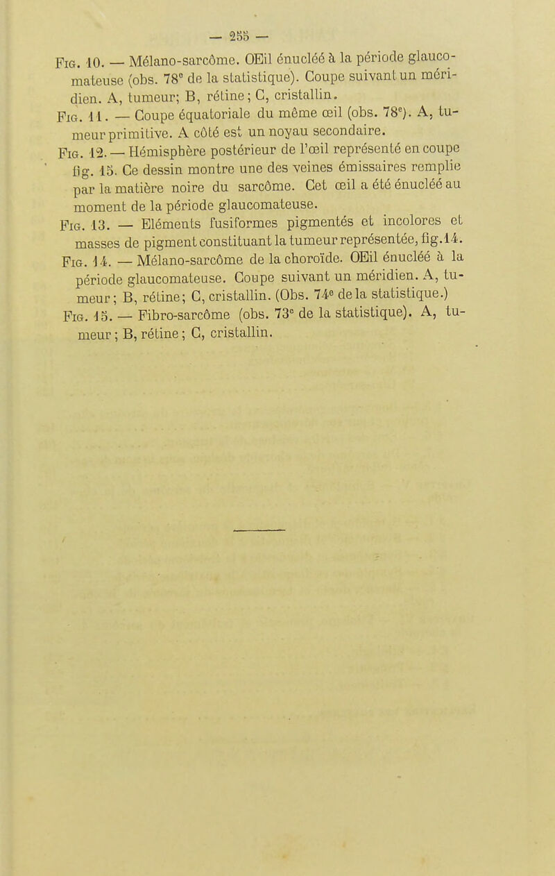 mateuse (obs. 78° de la statistique). Coupe suivant un méri- dien. A, tumeur; B, rétine; C, cristallin. FiG. il. — Coupe équatoriale du même œil (obs. 78). A, tu- meur primitive. A côté est un noyau secondaire. FiG. 12. — Hémisphère postérieur de l'œil représenté en coupe fig. 15. Ce dessin montre une des veines émissaires remplie par la matière noire du sarcôme. Cet œil a été énucléé au moment de la période glaucomateuse. Fig. 13. — Eléments fusiformes pigmentés et incolores et masses de pigment constituant la tumeur représentée, flg.l4. Fig. i A. — Mélano-sarcôme de la choroïde. OEil énucléé à la période glaucomateuse. Coupe suivant un méridien. A, tu- meur ; B, rétine; C, cristallin. (Obs. 74^ delà statistique.) Fig. IS. — Fibro-sarcôme (obs. 73° de la statistique). A, tu- meur ; B, rétine ; C, cristallin.