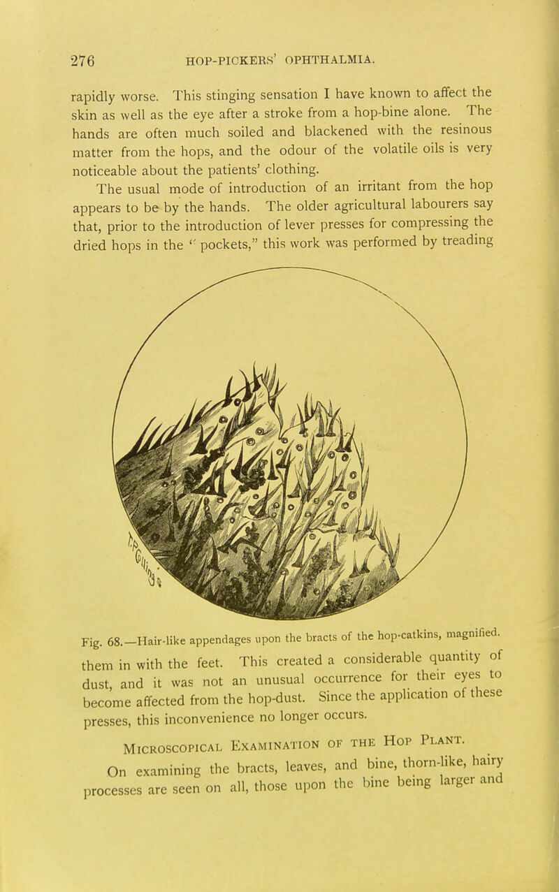 rapidly worse. This stinging sensation I have known to affect the skin as well as the eye after a stroke from a hop-bine alone. The hands are often much soiled and blackened with the resinous matter from the hops, and the odour of the volatile oils is very noticeable about the patients' clothing. The usual mode of introduction of an irritant from the hop appears to be by the hands. The older agricultural labourers say that, prior to the introduction of lever presses for compressing the dried hops in the '' pockets, this work was performed by treading Fig. 68.-Hair-like appendages upon the bracts of the hop-catkins, magnified, them in with the feet. This created a considerable quantity of dust and it was not an unusual occurrence for their eyes to become affected from the hop-dust. Since the application of these presses, this inconvenience no longer occurs. Microscopical Examination of the Hop Plant. On examining the bracts, leaves, and bine, thorn-like, ha.ry processes are seen on all, those upon the bine being larger and