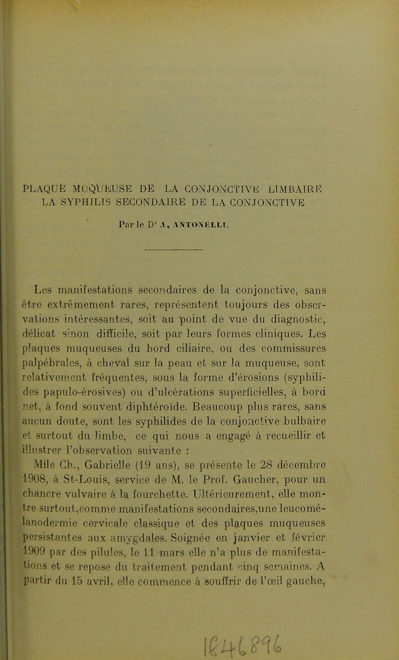 PLAQUË MOQUbJUSE Dfî LA GONJONCTIVli LlMBÀlRIî LA SYPHILIS SECONDAIRE DE LA CONJONCTIVE Par le D^ A. A.NTO.MÎLLI. Les manifestations secondaires de la conjonctive, sans être extrêmement rares, représentent toujours des obser- vations intéressantes, soit au point de vue du diagnostic, délicat sinon difficile, soit par leurs formes cliniques. Les plaques muqueuses du bord ciliaire, ou des commissures palpébralcs, à cheval sur la peau et sur la muqueuse, sont relativement fréquentes, sous la forme d'érosions (syphili- des papulo-érosives) ou d'ulcérations superficielles, à bord net, à fond souvent diphtéroïde. Beaucoup plus rares, sans aucun doute, sont les syphilides de la conjonctive bulbaire et surtout du limbe, ce qui nous a engagé à recueillir et illustrer l'observation suivante : Mlle Ch., Gabrielle (19 ans), se présente le 28 décembre 1908, à St-Louis, service de M. le Prof. Gaucher, pour un chancre vulvaire à la fourchette. Ultérieurement, elle mon- tre surtout,comm.e manifestations secondaires,une leucomé- lanodermie cervicale classique et des plaques muqueuses persistantes aux amygdales. Soignée en janvier et février 1909 par des pilules, le 11 mars elle n'a plus de manifesta- tions et se repose du traitement pendant -^inq semaines. A partir du 15 avril, elle commence à souffrir de l'œil gauche,