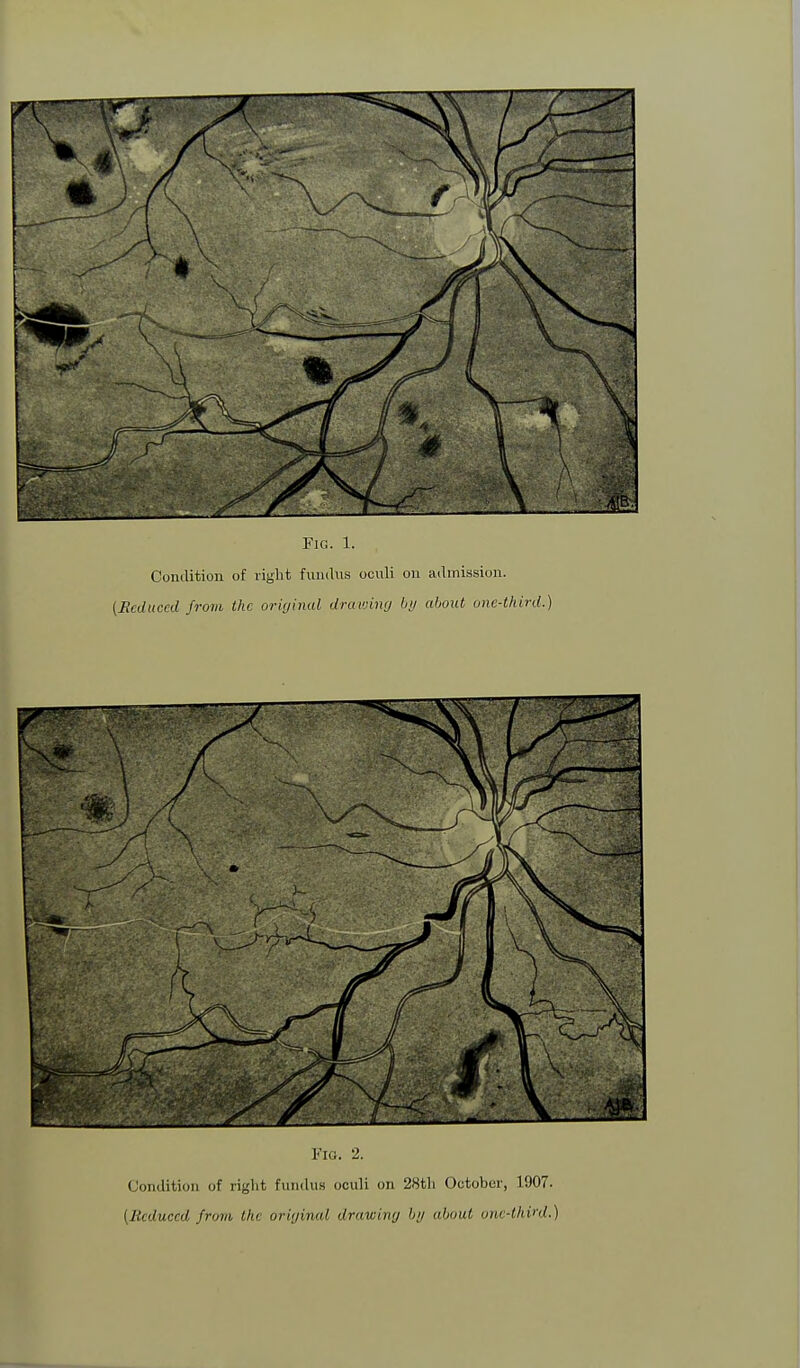 Condition of right fundus oculi on admission. (Seduced from the original drawing by about one-third.) I'lo. 2. Condition of right fundus oculi on 28th October, 1907. (Reduced from the original drawing by about one-third.)