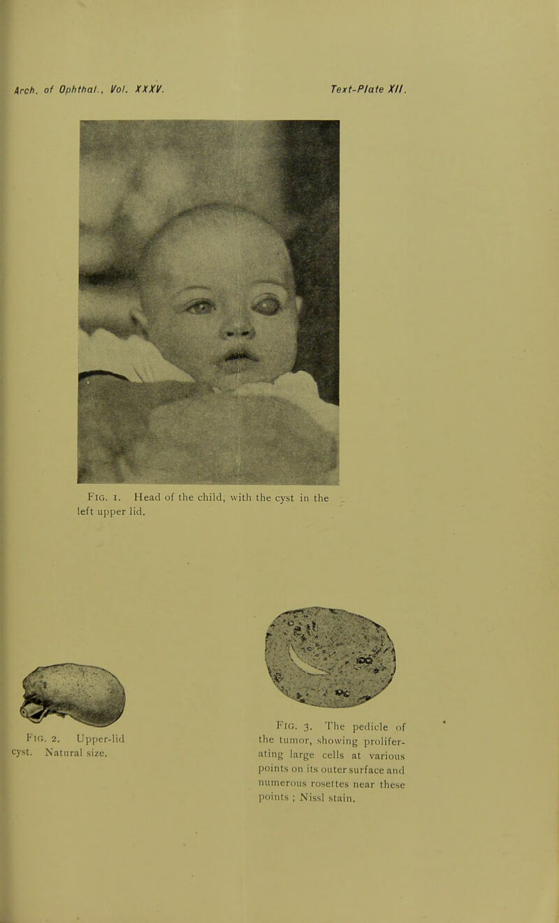 Arch, of Ophthal.. Vol. XXXV. Text-Plate XII. Fig. I. Head of the child, with the cyst in the left upper lid. Fig. 2. Upper-lid cyst. Natural size. '<-v;^> -wc- Fig. 3. The pedicle of the tumor, showing prolifer- ating large cells at various points on its outer surface and numerous rosettes near these points ; Nissl stain.