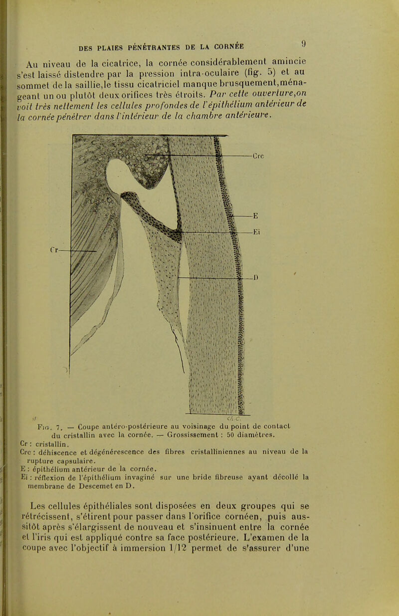 Au niveau de la cicatrice, la cornée considérablement amincie s'est laissé distendre par la pression intra-oculaire (fig. 5) et au sommet delà saillie,le tissu cicatriciel manque brusquement,ména- geant un ou plutôt deux orifices très étroits. Par cette ouverlure,on voit très nettement les cellules profondes de Vèpithélium antérieur de la cornée pénétrer dans lintérieur de la chambre antérieure. Fig. 7. — Coupe anléro-postérieure au voisinage du point de conlact du cristallin avec la cornée. — Grossissement : 50 diamètres. Cr : cristallin. Crc : déhi8cence et dégénérescence des fibres cristalliniennes au niveau de la rupture capsulaire. E : épithélium antérieur de la cornée. Ei : réflexion de l'épithélium invaginé sur une bride fibreuse ayant décollé la membrane de Descemet en D. Les cellules épithéliales sont disposées en deux groupes qui se rétrécissent, s'étirent pour passer dans l'orifice cornéen, puis aus- sitôt après s'élargissent de nouveau et s'insinuent entre la cornée et l'iris qui est appliqué contre sa face postérieure. L'examen de la coupe avec l'objectif à immersion 1/12 permet de s'assurer d'une