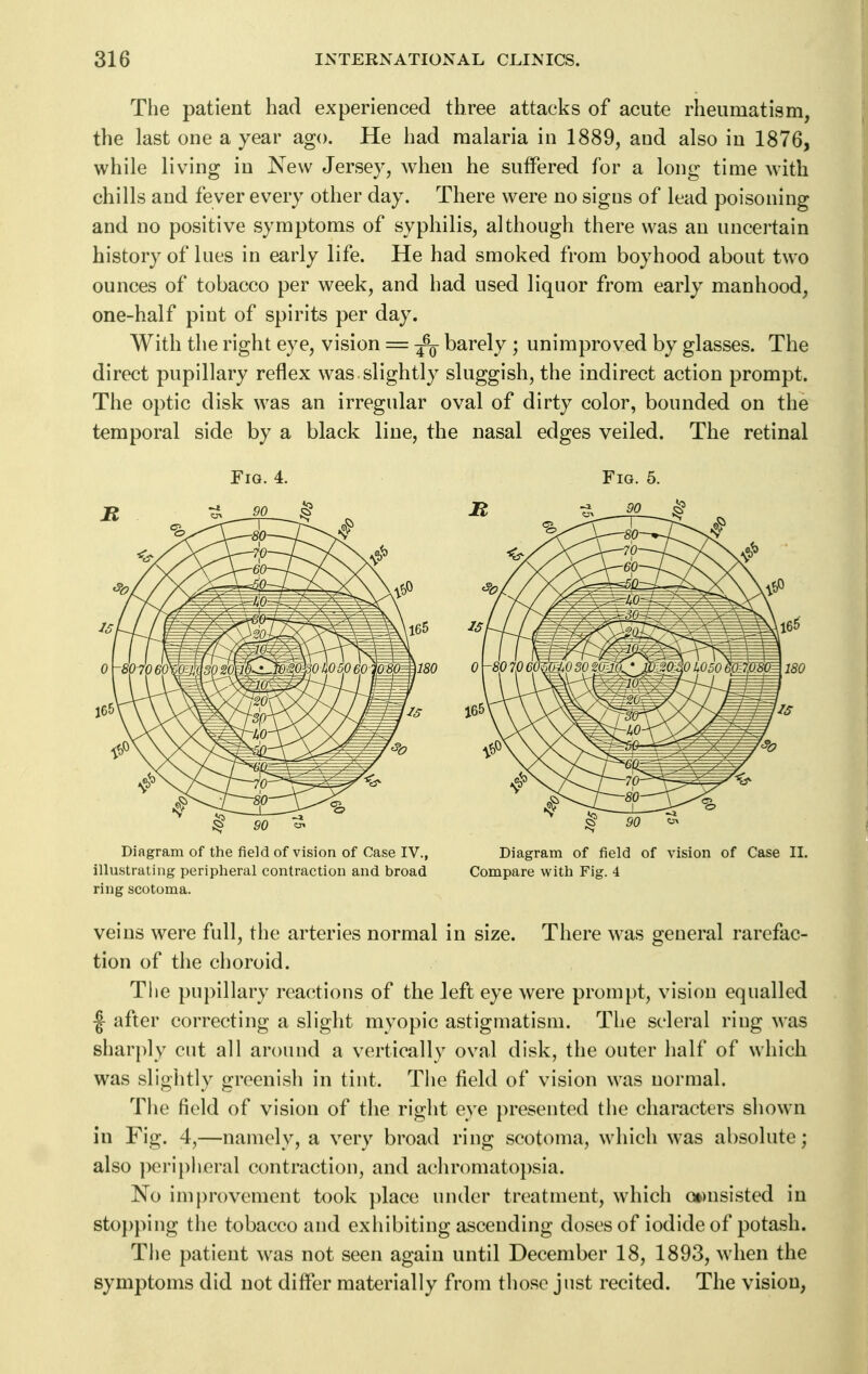 The patient had experienced three attacks of acute rheumatism, the last one a year ago. He had malaria in 1889, and also in 1876, while living in New Jersey, when he suffered for a long time with chills and fever every other day. There were no sigus of lead poisoning and no positive symptoms of syphilis, although there was an uncertain history of lues in early life. He had smoked from boyhood about two ounces of tobacco per week, and had used liquor from early manhood, one-half pint of spirits per day. With the right eye, vision = barely ; unimproved by glasses. The direct pupillary reflex was slightly sluggish, the indirect action prompt. The optic disk was an irregular oval of dirty color, bounded on the temporal side by a black line, the nasal edges veiled. The retinal Fig. 4. Diagram of the field of vision of Case IV., illustrating jjeripheral contraction and broad ring scotoma. Fig. 5. S 90 Diagram of field of vision of Case II. Compare with Fig. 4 veins were full, the arteries normal in size. There was general rarefac- tion of the choroid. The pupillary reactions of the left eye were prompt, vision equalled |- after correcting a slight myopic astigmatism. The scleral ring was shar})ly cut all around a vertically oval disk, the outer half of which was slightly greenish in tint. The field of vision was normal. Tiie field of vision of the right eye presented the characters shown in Fig. 4,—namely, a very broad ring scotoma, which was absolute; also peripheral contraction, and achromato})sia. No improvement took })lace under treatment, which c»)nsisted in stopping the tobacco and exhibiting ascending doses of iodide of potash. The patient was not seen again until December 18, 1893, when the symptoms did not differ materially from those just recited. The vision,