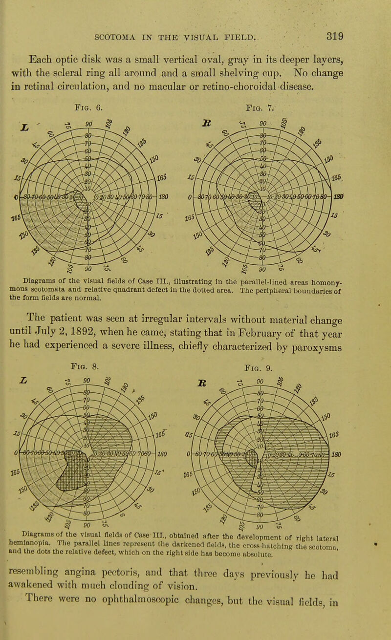 Each optic disk was a small vertical oval, gray in its deeper layers, with the scleral ring all around and a small shelving cup. No change in retinal circulation, and no macular or retino-choroidal disease. A165 0 J65 S 90 ^ Diagrams of the visual fields of Case III., illustrating in the parallel-lined areas homony- mous scotomata and relative quadrant defect in the dotted area. The peripheral boundaries of the form fields are normal. The patient was seen at irregular intervals without material change until July 2,1892, when he came, stating that in February of that year he had experienced a severe illness, chiefly characterized by paroxysms Diagrams of the visual fields of Case III., obtained after the development of right lateral hemianopia. The parallel lines represent the darkened fields, the cross hatching the scotoma and the dots the relative defect, which on the right side has become absolute. ' > resembling angina pectoris, and that three days previously he had awakened with much clouding of vision. There were no ophthalmoscopic changes, but the visual fields, in